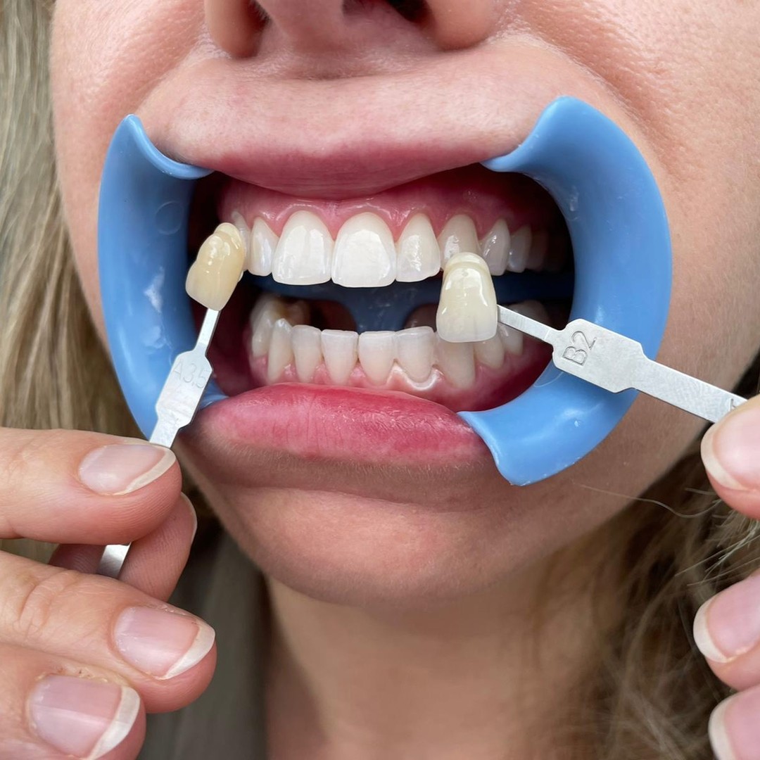 Bělejší zuby až o 10 odstínů!!!* 🦷 Rozjasněte svůj úsměv pomocí ordinačního bělení #Prevdent 🦷🦷🦷 Neváhejte a využijte objednávkový kalendář na webu (odkaz v popisu) #belenizubu #bezbolesti #teethwhitening #whitesmile #prague #dentalnihygiena #bilezuby *dle zabarvení zubů klienta