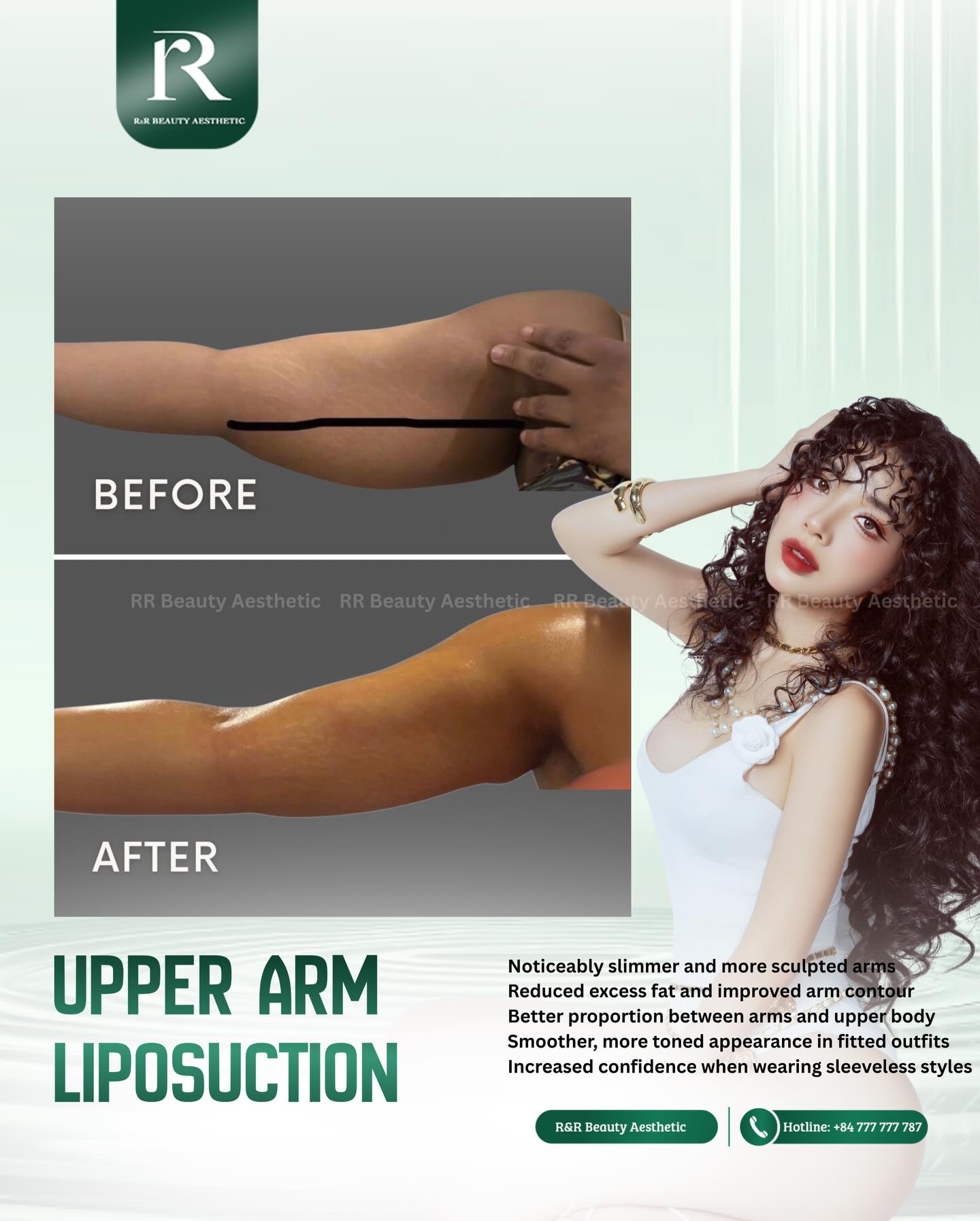 ✨ Upper Arm Liposuction
Sculpted Arms. Refined Silhouette. Renewed Confidence.
Stubborn upper arm fat can be resistant to diet and exercise.
With advanced upper arm liposuction, excess fat is precisely removed to:
✔ Noticeably slimmer arms
✔ Improved arm contour & definition
✔ Better balance between arms and upper body
✔ Smoother appearance in fitted outfits
✔ Increased confidence in sleeveless styles
💬 Book your private consultation today and redefine your arm silhouette.
📞 Hotline: +84 777 777 787
.
.
.
#upperarmliposuction #armliposuction #armfatremoval #bodysculpting #bodycontouring slimarms aestheticclinic cosmeticsurgery confidenceboost beforeafterresults
upper arm liposuction near me arm fat removal treatment best arm liposuction clinic body contouring consultation arm slimming surgery