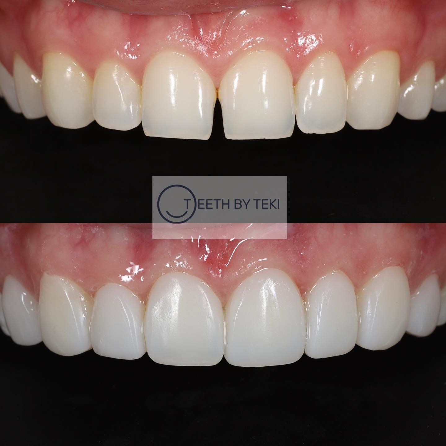 2 hours later … no drilling or injections
.
.
Composite bonding on 8 teeth to bring this smile to life 🤩💙
.
.
Learn how @trained_by_teki
.
.
#teethbyteki #compositebonding