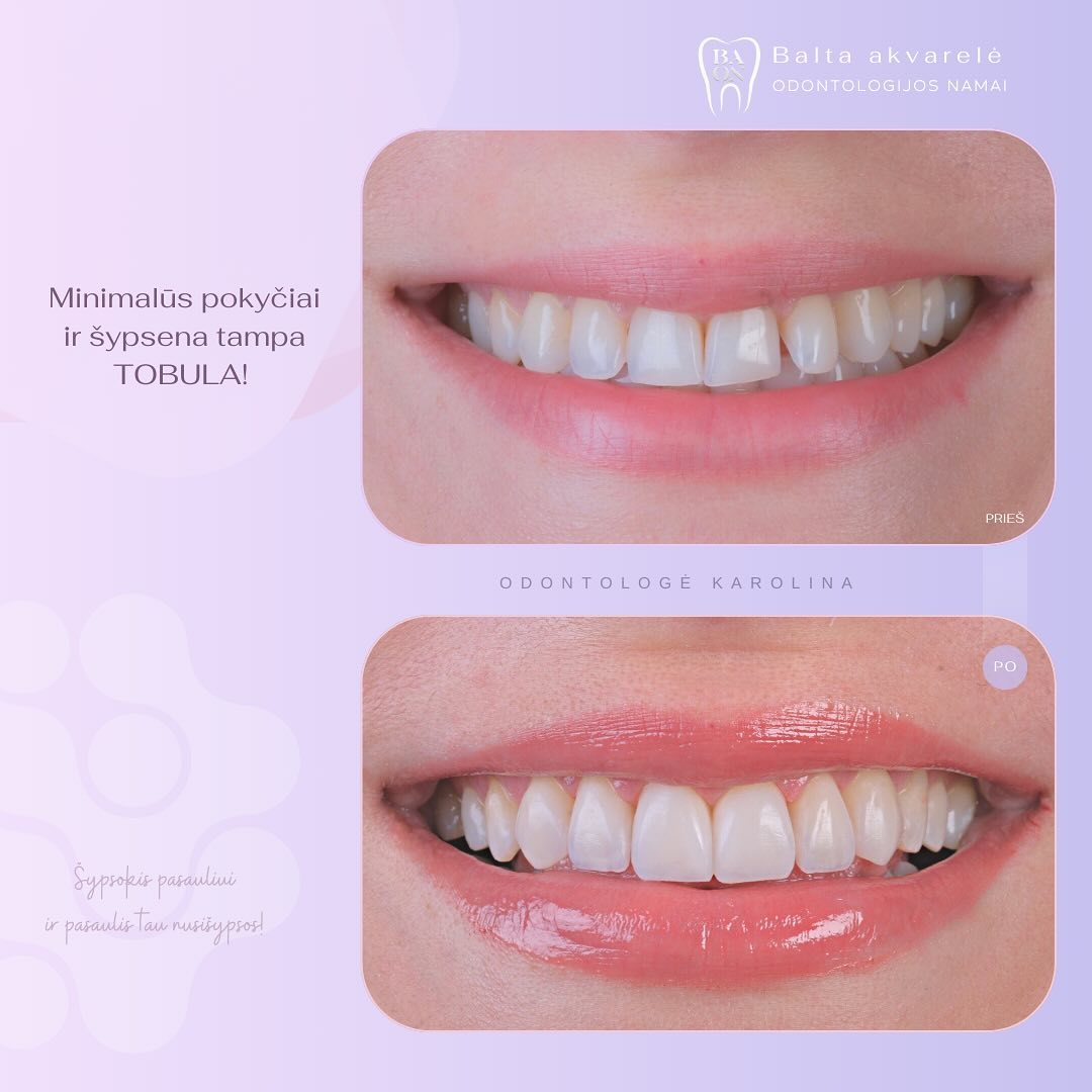 Šoninių paviršių plombavimas bei kandamūjų krastelių atstatymas kompozitu.
#estetinisplombavimasklaipeda #odontologijosklinikaklaipėdoje #karolina4smile #baltaakvarele