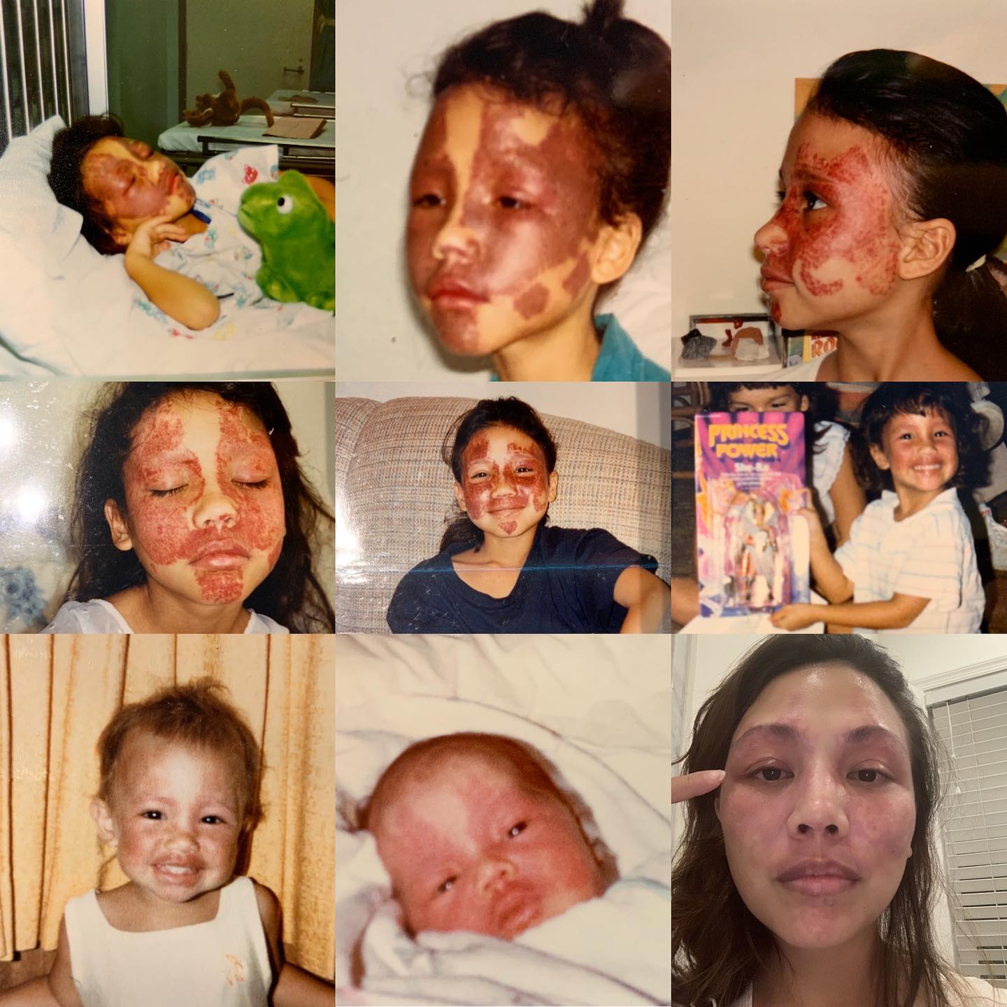 These are pictures of me after treatments at age 6, 7, 8, and 9 years old. I have also included childhood images so you can compare my PWS then and now. For me, I have mild Sturge Webber with a larger port wine stain on my face and legs. The pulse dye laser is more for maintenance for me and not for expecting or looking for my port wine to fully clear. The treatment keeps its growth at bay and helps stave of any complications to my eyesight and any of the other sensitive structures nearby. My Port Wine stain slowly grows and thickens if left unchecked. I would love to hear why or why not any of the #sturgeweber #portwinestain #birthmark community chooses to treat or not treat their own birthmarks.