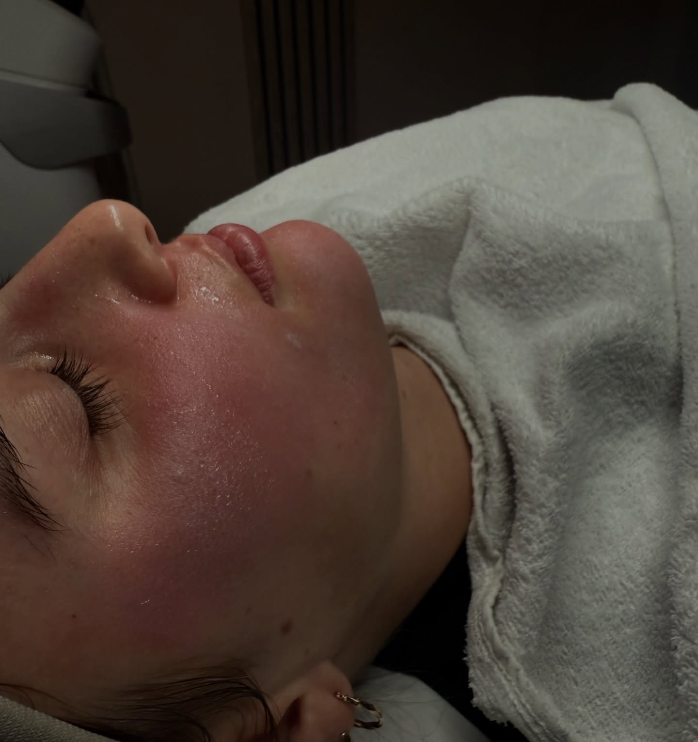 After performing a TCA peel at Lana Skyn, a white “frosting” effect can appear on the skin during the treatment.
This frosting happens when the trichloroacetic acid causes controlled coagulation of proteins in the upper layers of the skin. It is a normal and expected reaction, and it shows that the peel is actively working at the correct depth.
The level of frosting helps determine how deeply the peel has penetrated and guides the treatment safely. TCA peels are excellent for improving acne scars, pigmentation, sun damage, fine lines, and uneven skin texture.
In the days after the treatment, the skin may feel tight, dry, and slightly swollen. Peeling usually starts around day two or three and can last up to a week, depending on the strength of the peel.
During this time, it is important not to pick or pull the skin, allowing natural shedding to happen. New skin underneath will look fresher, smoother, and more even in tone.
With proper aftercare and SPF protection, results continue to improve as collagen stimulation supports long-term skin renewal.