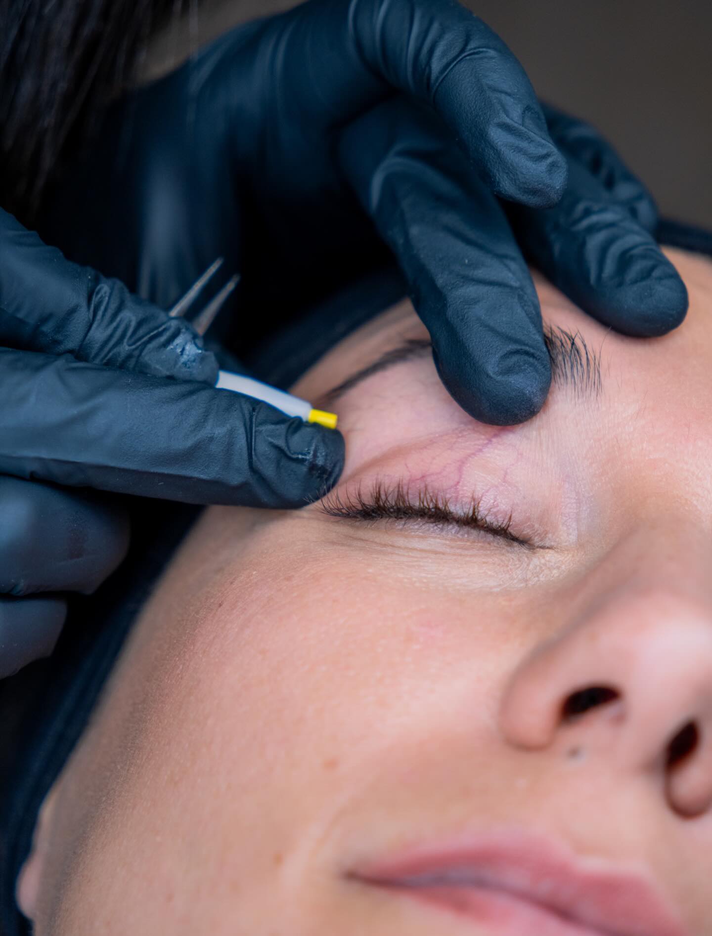 Quand le laser ne suffit pas, l’épilation électrique Apilus prend le relais.
Chaque follicule est traité individuellement grâce à une impulsion ultra ciblée.
Résultat : destruction définitive du bulbe, sans dépendre de la couleur du poil ou du phototype.
Ici, travail de précision sur la zone du sourcil :
✔️ Correction de ligne
✔️ Suppression des repousses isolées
✔️ Finition nette et durable
C’est un travail minutieux, où chaque poil compte.
💬 Tu hésites entre laser et électrique ? Écris-moi en DM, je t’oriente selon ton cas.
#Apilus #EpilationElectrique #PoilsClairs #EpilationVisage #DermoEsthetique