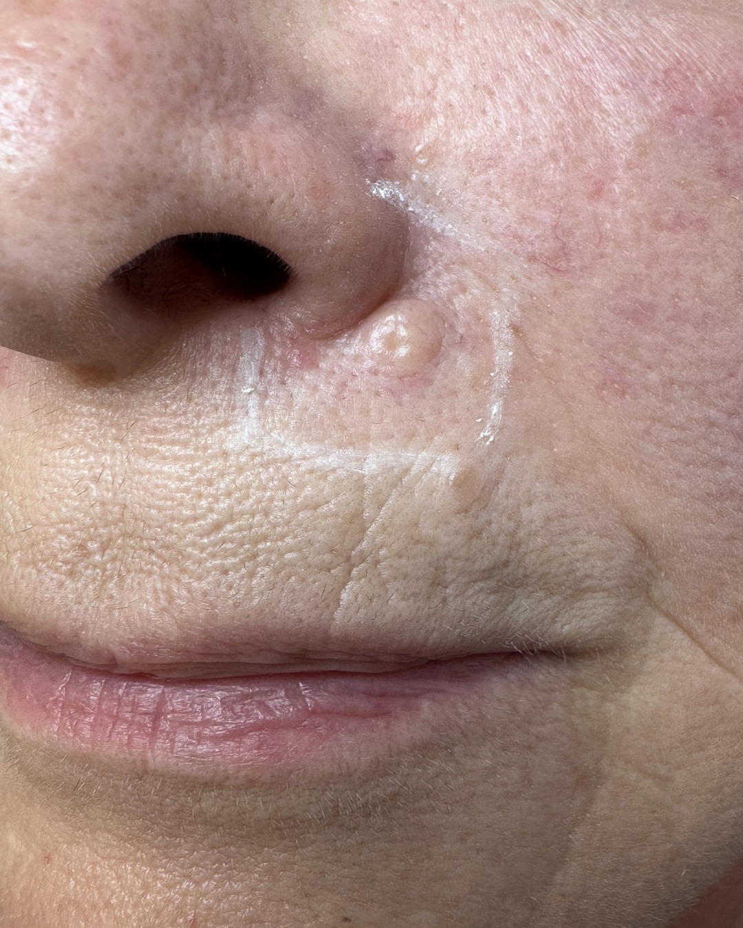 Do you have a blemish that you feel looks a bit funny? Has a mole recently changed shape or become itchy?
Monitoring and checking your moles and blemishes is so important, and could save your life!
If you’re unsure, it’s always best to just get it checked out.
February is National Cancer Prevention Month, and as the month comes to an end, we want to remind you that checking your moles and blemishes could lead to early detection of skin cancer.
At The Expert Skin Clinic, we offer Map My Mole, an accessible mole and blemish screening service that is transforming the diagnosis of suspicious skin blemishes.
Please don’t put it off, book a blemish consultation with us and we’ll take you through the whole process. Advanced technology allows us to screen the mole or blemish within our clinic, send it off, and get the results back within 48hrs - leading to peace of mind or early detection!
Book your blemish consultation on our website💙
#NationalCancerPreventionMonth #CancerPrevention #SkinCancer #MoleMapping #SkinCancerPrevention #SkinCancerAwareness