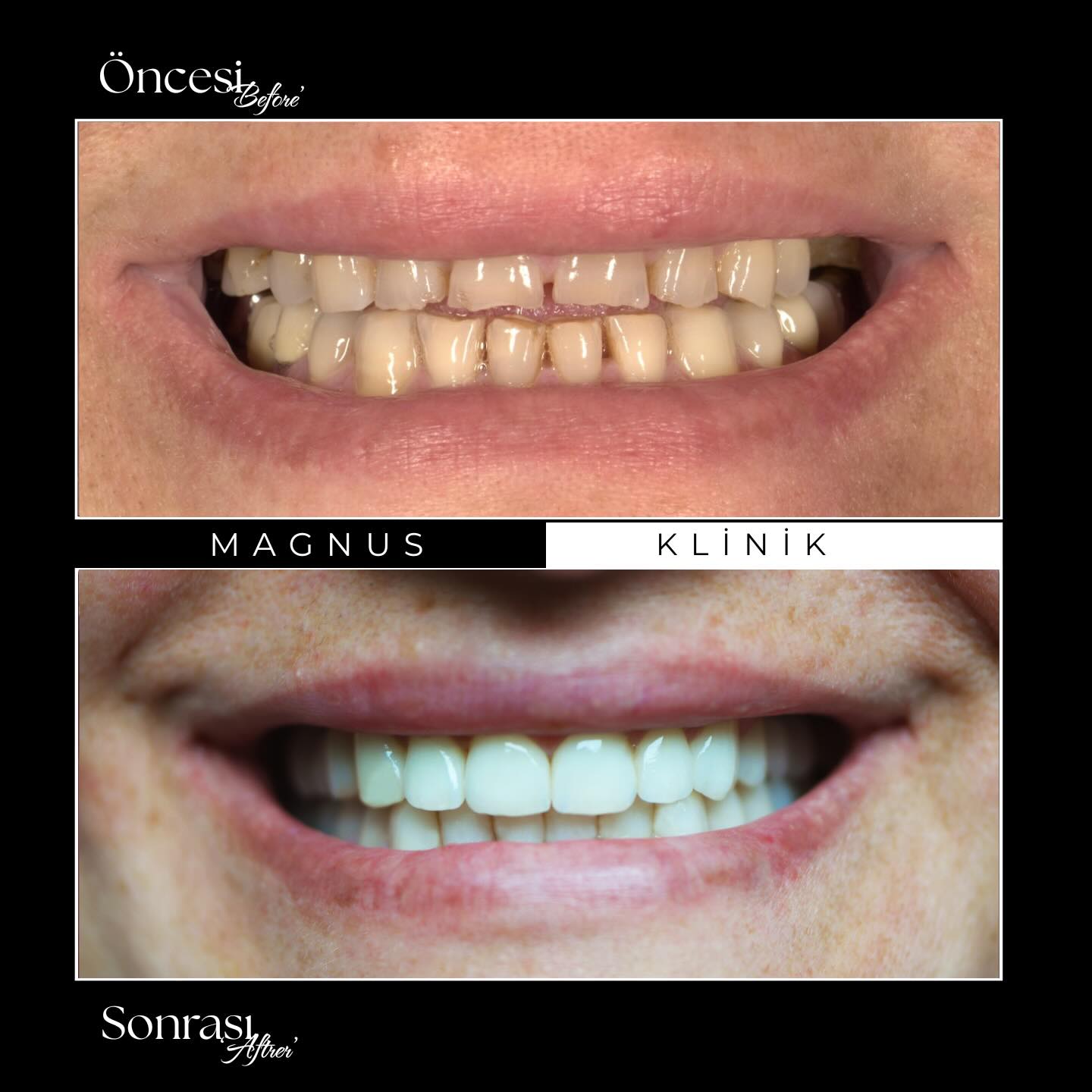 * Bu paylaşım bilgilendirme amaçlıdır; tanıtım ve reklam niteliği taşımaz.
* Paylaşım yönetmelik gereği yoruma, beğenilere kapatılmıştır.
* Paylaşılan görüntüler, kliniğimizde tedavi gören hastamızın açık rızası alınarak yayımlanmıştır.
* Bu içerik, 12.11.2025 tarihli Resmî Gazete’de yayımlanan Sağlık Hizmetlerinde Tanıtım ve Bilgilendirme Faaliyetleri Hakkında Yönetmelik’in 7. maddesine uygun olarak hazırlanmıştır.
* Her cerrahi veya girişimsel işlemde sonuçlar kişiden kişiye değişiklik gösterebilir. İşlem öncesinde hekiminizden detaylı görüş almanız önerilir.
✨ 𝐌𝐚𝐠𝐧𝐮𝐬 | 𝐺𝑢̈𝑙𝑢̈𝑠̧𝑢̈𝑛 𝑂̈𝑡𝑒𝑠𝑖𝑛𝑑𝑒 🦷✨