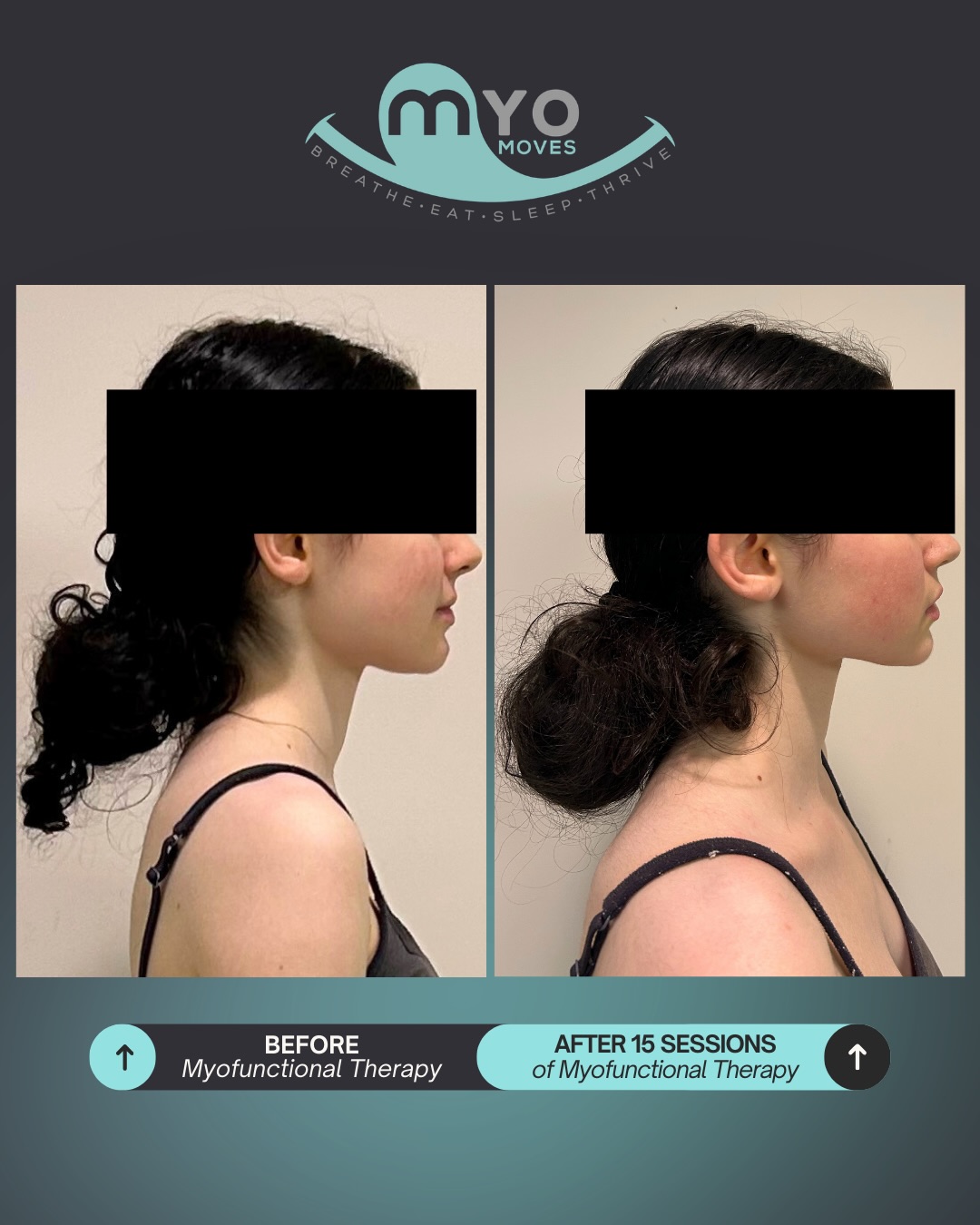 Same patient - 15 sessions, new habits, and a tongue tie release and the difference isn’t subtle!
When you look at the before, notice how her head sits slightly forward and her shoulders round inward. That forward head posture isn’t just a habit. It’s often the body’s way of trying to create more space to breathe. When the airway feels restricted, the head shifts forward, the shoulders collapse, and the neck muscles work overtime just to keep airflow moving.
Now look at the after - her head is more naturally stacked over her shoulders. Her shoulders are relaxed instead of pulled forward. Her neck looks longer. Her upper body looks more open. That change didn’t happen because we told her to “stand up straight.” It happened because we addressed a tongue tie, and worked on oral posture, tongue position, and nasal breathing.
When the tongue rests on the palate and the airway is more stable, the body doesn’t need to compensate anymore. Posture improves because breathing improves. And when breathing improves, everything from sleep to focus to growth patterns can shift in a positive direction.
This is why we look at the whole picture! If your child consistently stands with their head forward and shoulders rounded, it might not just be posture. It could be an airway clue.
If this makes you curious, comment GUIDANCE and let’s start the conversation!
#tonguetie #beforandafter #myofunctionaltherapy #airwayhealth #tongueposture