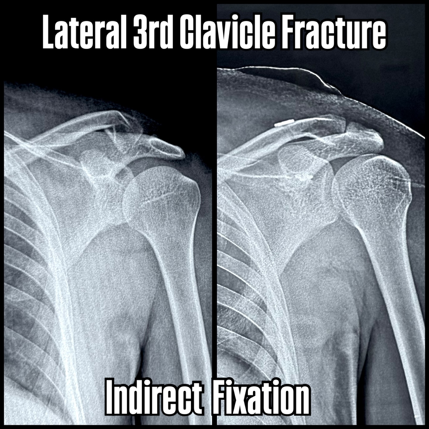 Collarbone or Clavicle can get fractured in various ways and can be managed in multiple ways as well.
Unstable lateral third clavicle fractures are notorious and usually need surgical fixation.
Indirect Suspensory Fixation with a TightRope and Dog-bone button offers a minimally invasive & strong fixation option with lesser chances of complications & a quicker recovery.
#shoulder #shoulderinjury #fracture #shouldersurgery #arthrosports