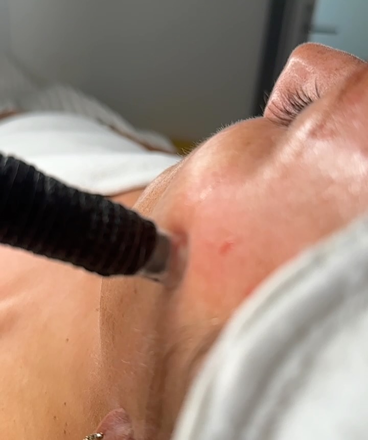 3 Things to remember about you Microneedling treatment >>>> swipe to see ๐ซถ
Comment MICRONEEDLING below for your one time exclusive offer ๐ซถ๐