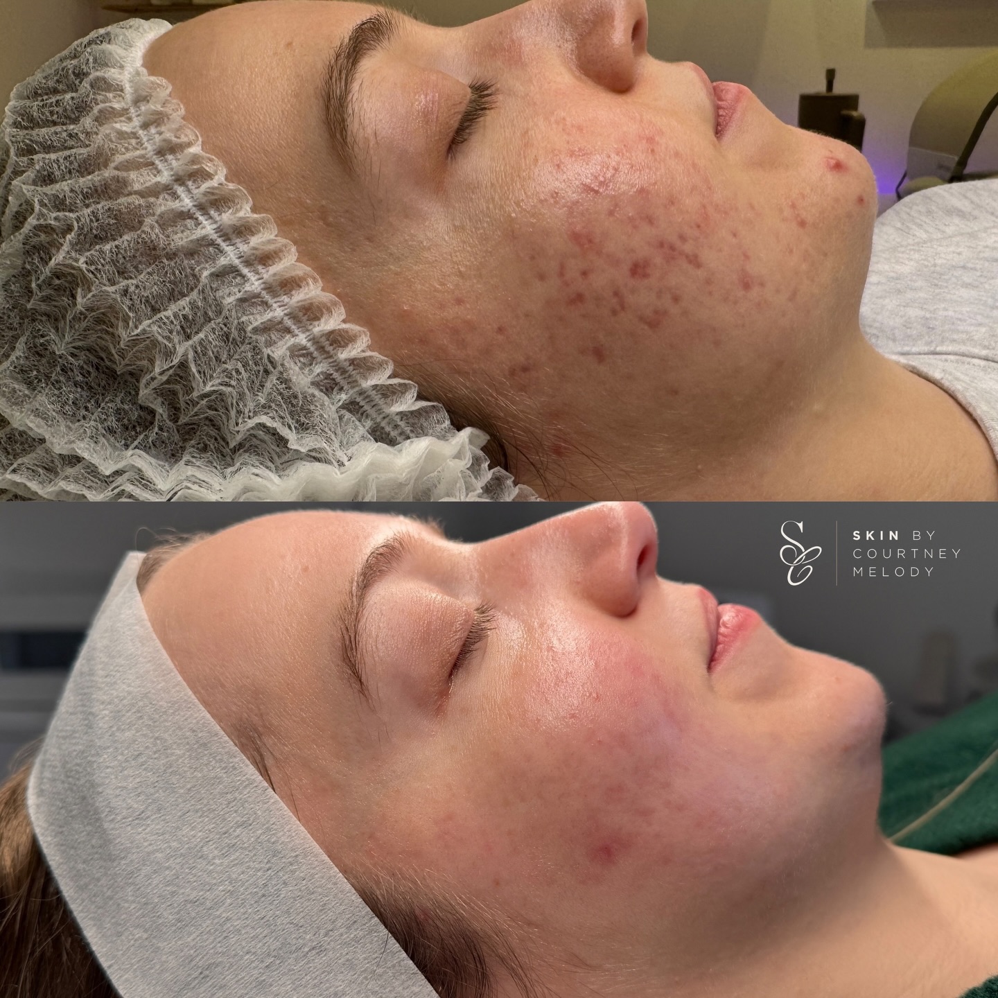 First transformation of 2026 and what incredible results to kick the year off!
When my client first came in for consultation, her skin was inflamed, sore, and sensitive. This was affecting her confidence, and despite her efforts, she hadn’t been able to resolve the issues herself.
Upon skin analysis, it was clear her skin barrier was compromised. Low hydration was driving increased oil production, creating a cycle of imbalance. When the barrier is impaired and hydration is low, cellular turnover and shedding slow down, as the enzymes responsible for these processes require adequate water to function effectively.
We began with a prescriptive homecare routine to restore and strengthen the barrier. Once her skin tolerance improved, we introduced targeted actives such as retinal and vitamin C to address scarring and pigmentation.
In clinic, we performed 10 treatments in total. including tailored facials and SkinPen microneedling, to accelerate repair and rejuvenation. The results speak for themselves, healthy, resilient, and balanced skin!
Swipe for her kind words ♥️