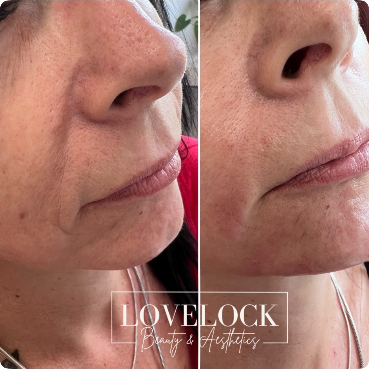 Jowl, nasolabial fold and marionette correction using dermal filler is one of the most effective ways to restore lower-face structure and create a fresher, lifted appearance without surgery.
⸻
Restores Lost Volume
As we age, we lose collagen, elastin and deep fat pads. This causes sagging around the jowls and deepening of the nasolabial folds and marionette lines.
Dermal filler replaces lost volume, helping to rebuild structural support and soften shadows.
📍 Romsey 📍 Warminster
Level 7 expert practitioner
#warminster #westbury #trowbridge #melksham #devizes