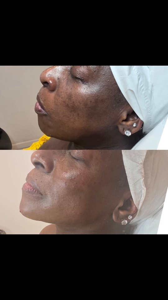 ✨ rebalancing BEFORE & AFTER ✨
Subtle changes, powerful results.
5ml
This beautiful transformation was achieved with 5ml of facial rebalancing combined with upper face wrinkle treatment to soften lines and restore harmony across the face.
The goal? Not to change her features but to enhance, rebalance, and refresh while keeping everything natural.
💉 Treatment highlights:
• 5ml facial rebalancing
• Upper face wrinkle treatment
• Smoother forehead
• Restored facial balance
• Natural, refreshed result
Every treatment is tailored to the individual, focusing on balance, proportion, and subtle rejuvenation.
📍DM to book your consultation
📅 Limited appointments available
#beforeandafter #facialrebalancing #aestheticsclinic #antiwrinkle #naturalaesthetics
