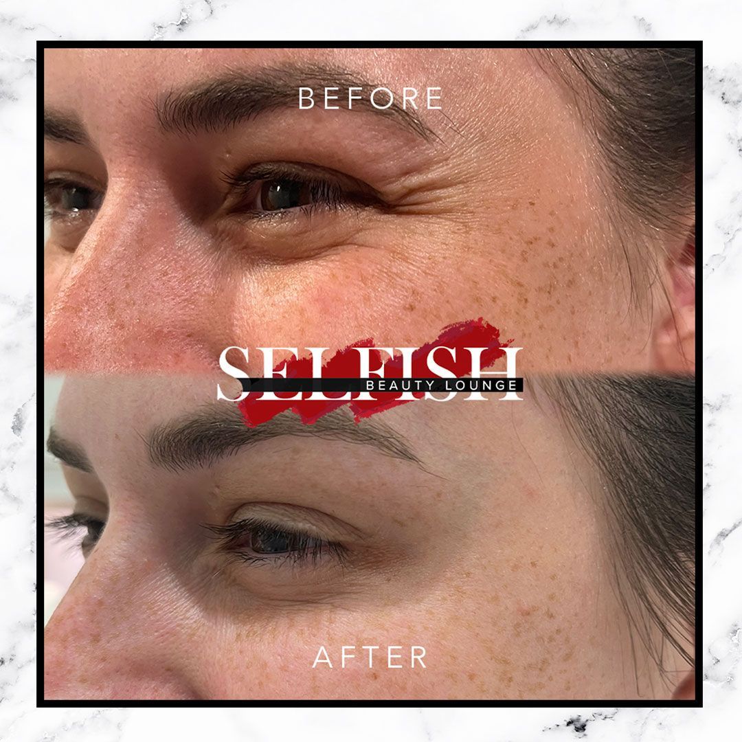 Here's the scoop on these fabulous Botox results:🌟
Before: Expressive and beautiful, but maybe a few lines to soften.😊
After: Smooth, radiant skin that reflects a confident and empowered client! ✨
Feeling good in your skin is a game-changer! Embrace it!💁♀️
Book a consult with us today by clicking the link in our bio.💕
#BotoxBeauty #LoveYourSkin #SelfishBeautyLounge
#selfcarevaughan
#affordableluxury
#beautyservicesvaughan
#beautyserviceswoodbridge
#beautyservicestoronto
#botoxwoodbridge
#botoxvaughan
#botoxtoronto
#beautyvaughan