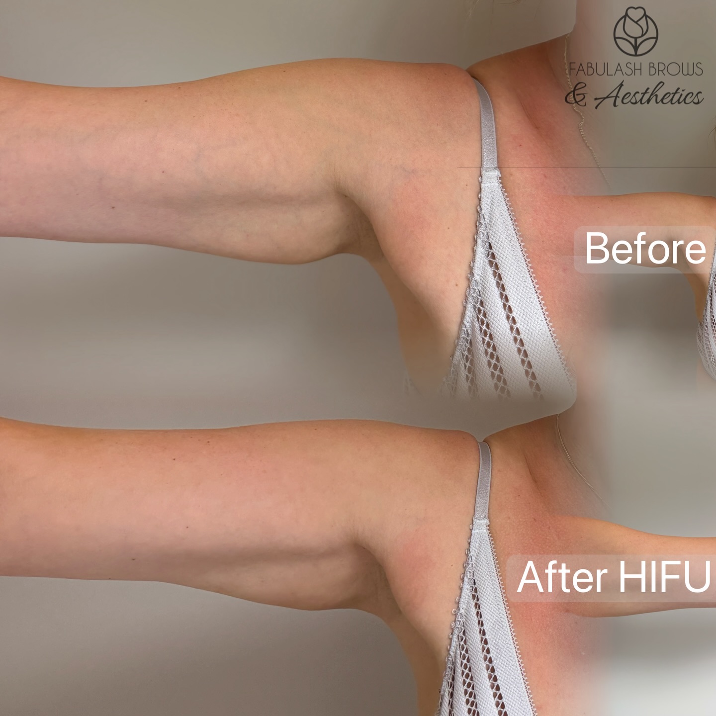 💁♀️Upper Arm tightening with FBA HIFU treatment! Get instant results right after and continue for the next 3 months💪💪!
Book online for free consultation with our specialist !
Www.fabulashbrows.co.nz
🏡Level 5, 76 Manners street, Wellington
☎️ 0221308020
.
.
.
#hifu #facelifting #hifuwellington #skintightening #noninvasivetreatment