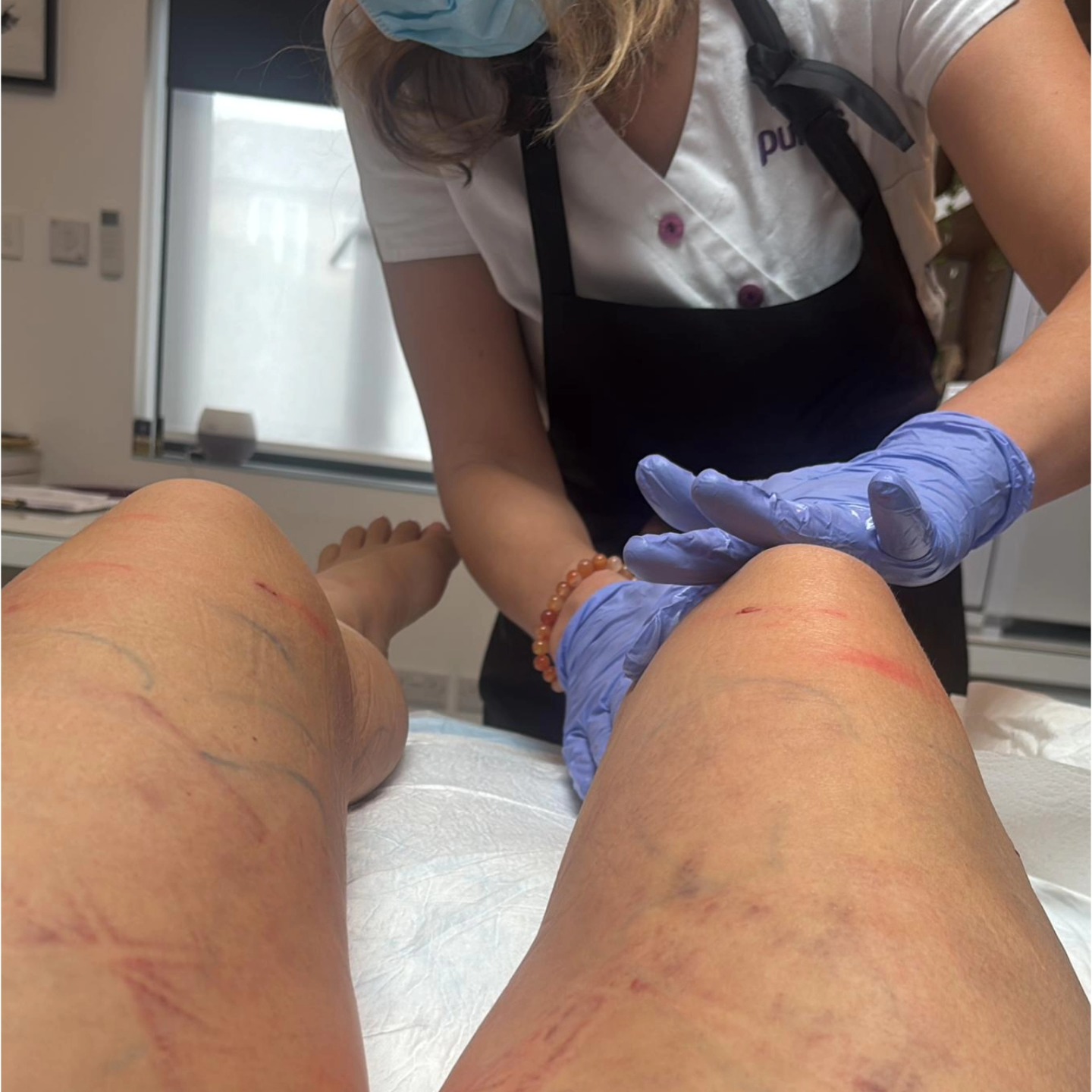 Post lipedema surgery treatment day 2 .
Client reports on a lot of pain: swelling and soreness.
Helping with garment undressing
Therapy requires a gentle approach, yet a lot can be done to help the lymph to drain through incisions and prevent stagnation. Client books for min 10 to 12 visits weekly as recommended by a surgeon. I am very pleased to see the client recovery journey .
#manuallymphdrainage
#postsurgerycare
#lipodemasurgery