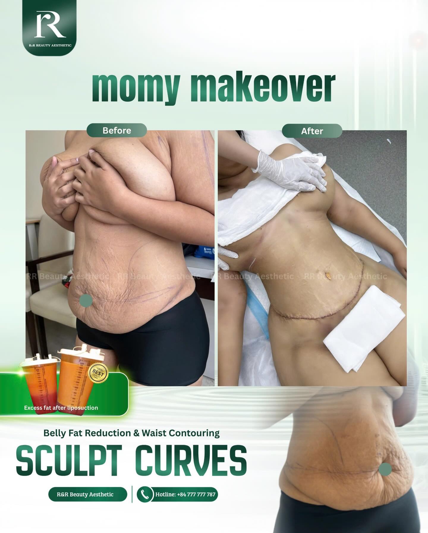 ✨ MOMMY MAKEOVER – SCULPT CURVES AGAIN
Pregnancy changes your body.
But it doesn’t define your shape forever.
Loose skin.
Stubborn belly fat.
Postpartum sagging that won’t go away no matter how much you diet or exercise.
At R&R Beauty Aesthetic,
🔥 5 RESULTS YOU RECEIVE
1️⃣ Flatter, Sculpted Abdomen
2️⃣ Improved Skin Tightness
3️⃣ Better Body Proportion
4️⃣ Reduced Postpartum Sagging
5️⃣ Renewed Confidence
📩 DM us for a personalized consultation
📞 Hotline: +84 777 777 787
.
.
.
#mommy makeover #postpartumbody #bellyfatremoval #waistcontouring #bodytransformation
mommy makeover vietnam, postpartum belly sagging treatment, abdominal liposuction after pregnancy, waist contouring procedure, belly fat reduction clinic vietnam