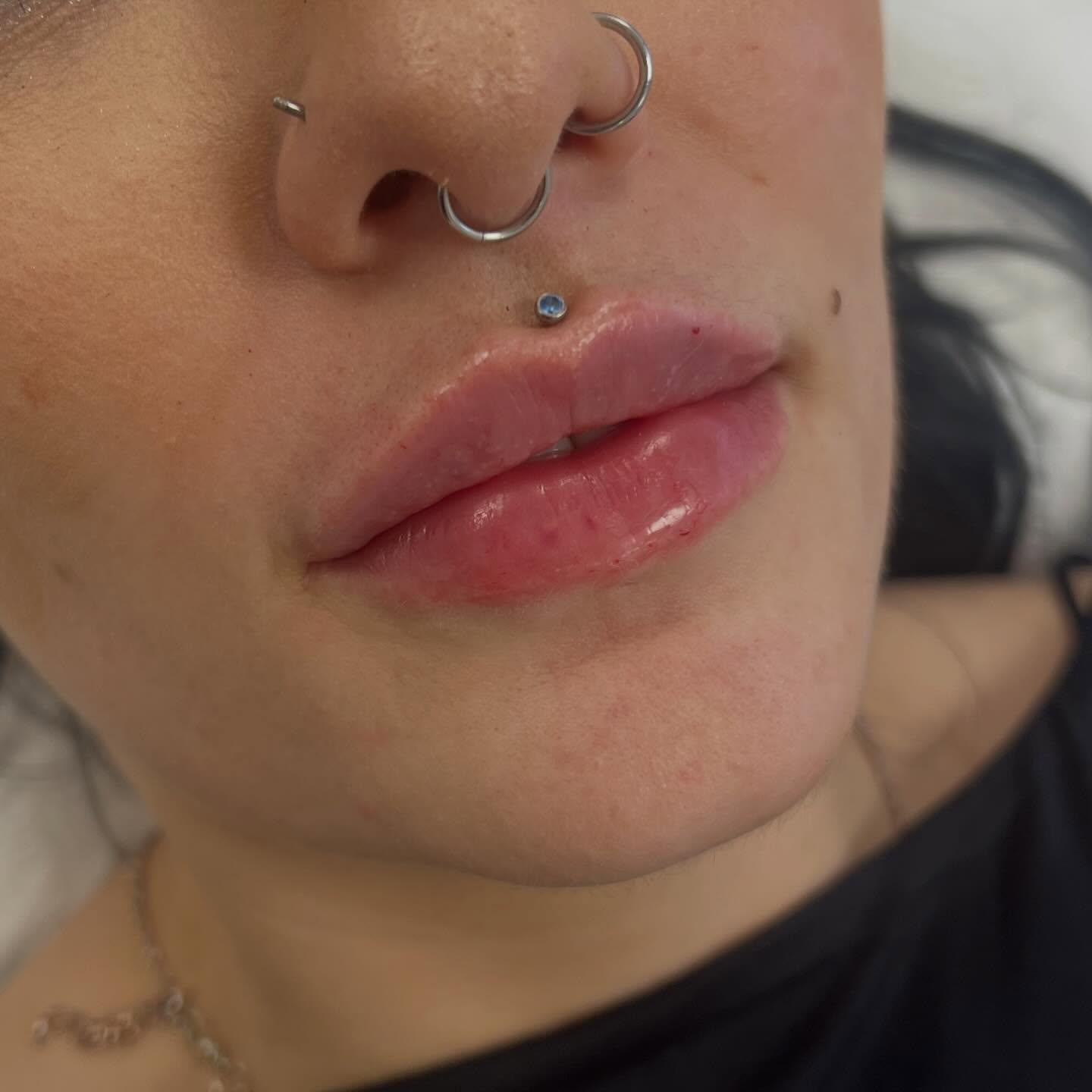 Dissolve and Refill
my lovely client had been putting off dissolving her previous lip filler for quite a long time. She finally took the plunge and two weeks later we used 1.3 ML @lumifil_uk to create the shape she wanted
We have seen a rise in elective dissolve, a patch test is required and a highly diluted conservative dose of hyalase is used to remove the filler.
Book your free consultation today.
R x