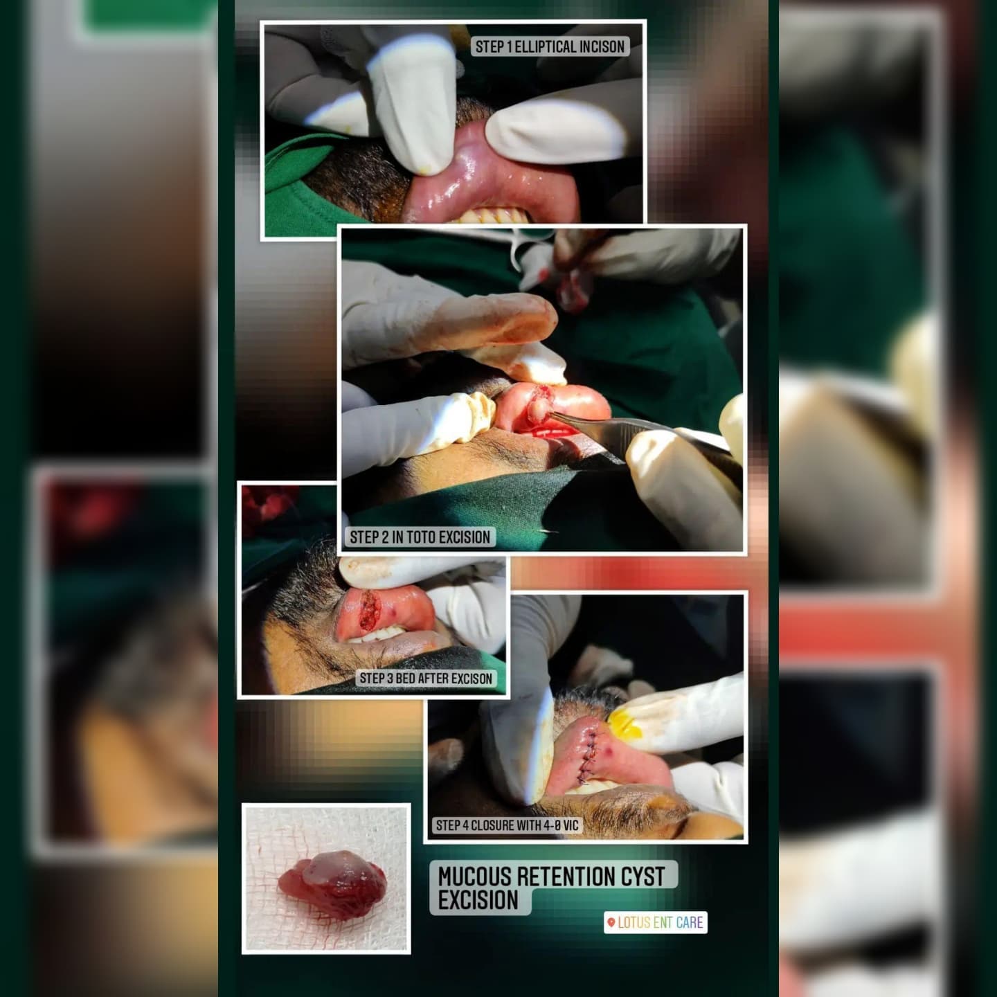 Mucosal cyst excision of lip
A mucous cyst, also known as a mucocele, is a fluid-filled swelling that occurs on the lip or the mouth.
Lip biting and trauma to the face or mouth are common causes these mucocele are most frequently seen in people younger than age 20.
The cyst develops when the mouth’s salivary glands become plugged with mucus. Most cysts are on the lower lip, but they can occur anywhere inside your mouth. They’re usually temporary and painless.
But it they are recurring or permanent , a simple excision under local anesthesia is all that's needed. Its just a 30 min day care procedure .
Do get in touch with us to know more
9008735781 , www.lotusentcare.com
#mucuscyst #mouthcare
#mucosal #oralcare #lipsurgery #entcare #lotusentcare #drkamalpandyan #cystremoval