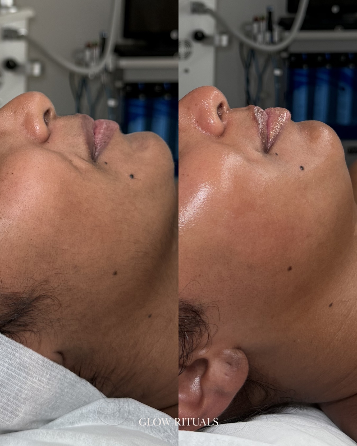 Lets talk about Dermaplaning👇🏻
What is it?
A form of physical exfoliation that removes built-up dead skin cells and vellus hair (aka 🍑 fuzz). This is why the skin feels instantly smoother and looks brighter!
On healthy, resilient skin barriers this can be a beautiful treatment✨
However, if your skin barrier is already impaired (think inflammation, dehydration, acne or redness), removing that outer layer can increase transepidermal water loss, heighten sensitivity and place additional stress on skin that’s already struggling💢
Over the years, I’ve seen more impaired skin barriers caused by over-exfoliation some due to excessive dermaplaning habits. It’s not that dermaplaning is the problem. But barrier integrity and long-term skin health should always come first!
Because healthy, resilient skin will always deliver a better glow than any quick fix
🔗 link in bio to book your next facial, our books are filling up quickly with limited availabilities so be sure to book in advance
🤍Laura
#sydneyfacial #dermaplaning #skinhealth #casulabeauty #skincaretips