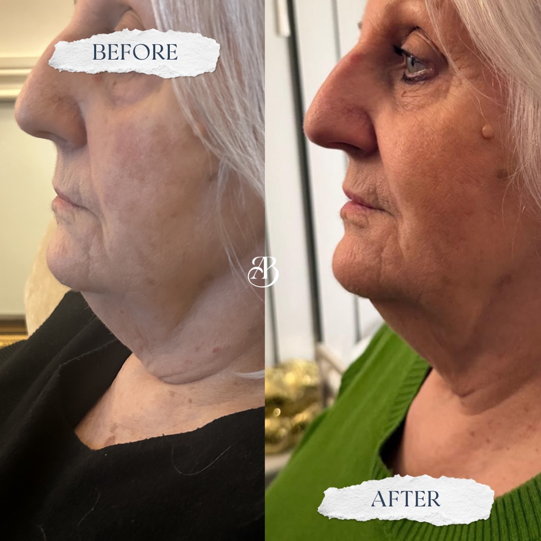 Neck Rejuvenation with Teoxane Redensity 1 🤩
Subtle, naturally and beautifully refreshed ✨
We’ve started a course of Redensity 1 to treat the neck area on this gorgeous mature client, and even after just ONE treatment we are seeing improved skin quality, hydration and subtle tightening effects!
The neck is often one of the first areas to show signs of ageing due to thinner skin, reduced collagen and constant movement. Redensity 1 works to gently revitalise and restore from within 🤍
Whilst one treatment gives a glow, initial tightening and improved skin quality, optimal results come from a course of 3 treatments, spaced 3 weeks apart.
We are SO excited to see this continued transformation 🥰
📍Oldswinford, Stourbridge
Message us, or follow the link in our bio, to book your consultation today 📩
#teoxane #skinboosters #mature #collagen #nurseledclinic