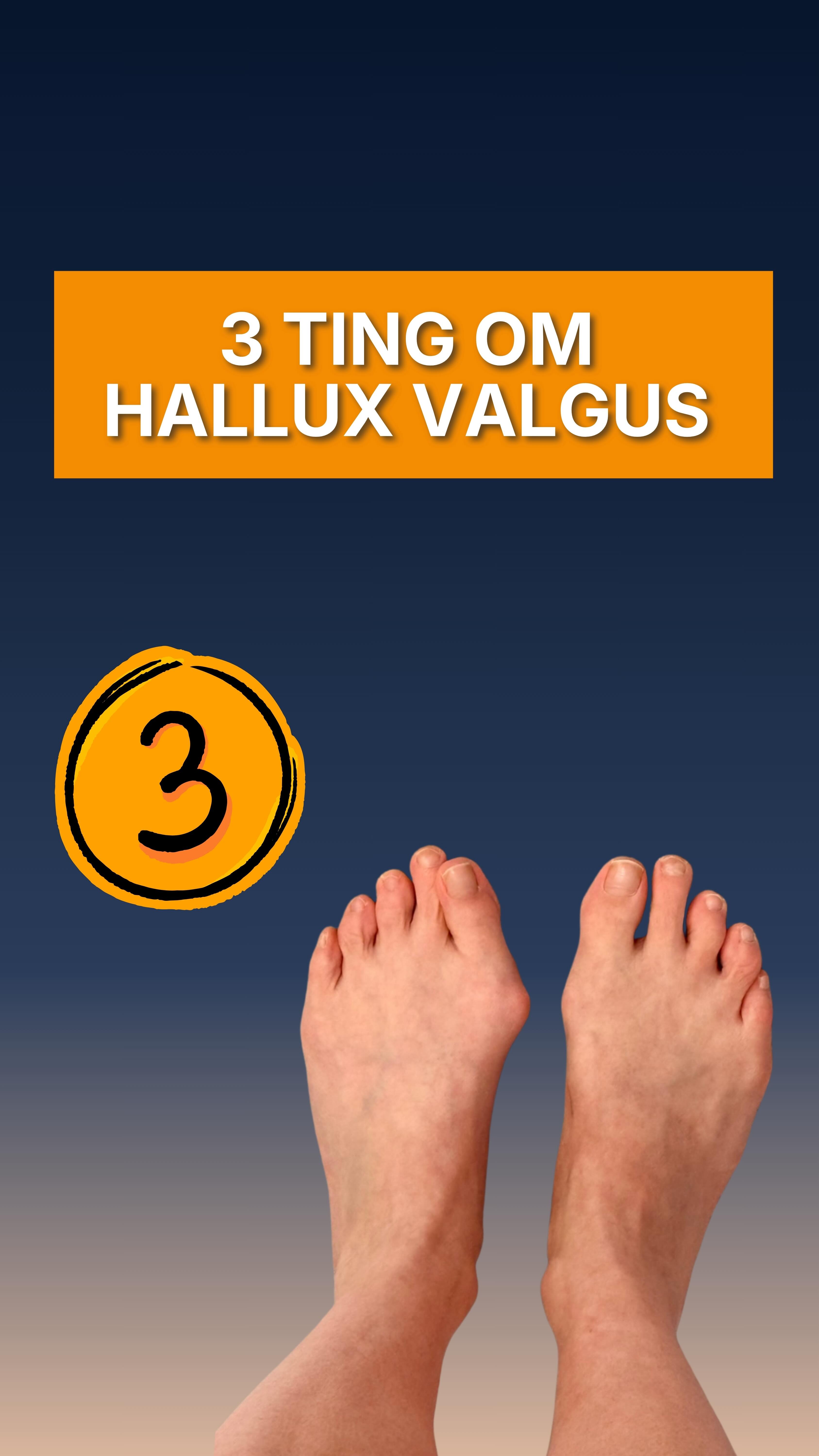 Disse må du få med deg om du lider av hallux valgus ⚠️🦶