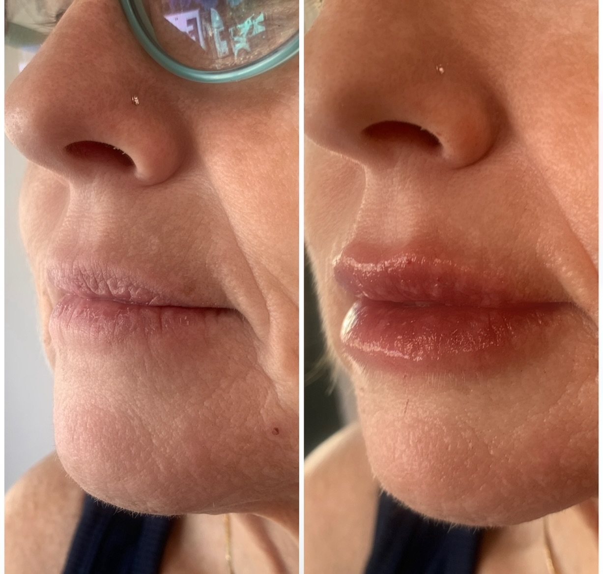 Before ➡️ After 💋✨
No needle. Just precision.
This is a HYA Pen lip treatment — designed to gently plump, hydrate, and sculpt while softening fine lines around the mouth for a more youthful look.
Notice the added shape, hydration, and smoothness 👏🏼
It’s not about “big” — it’s about balanced, defined, anti-aging lips that still look like YOU.
Perfect for mature lips that have lost volume or definition over time.
Ready for a subtle glow-up? 💄✨
#HyaPen #yosemite #LipPlump #laketulloch #sonora