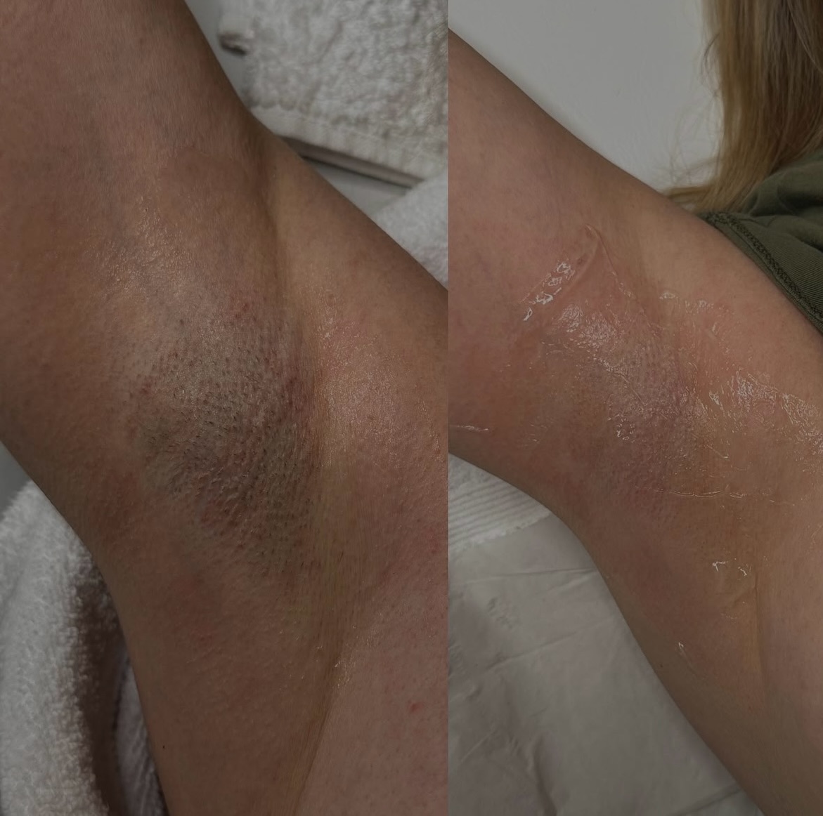 Brazilian of bikinilijn laseren?
De keuze gaat niet over beter of slechter.
Het gaat over hoeveel haar je wilt verwijderen en hoeveel onderhoud je wilt behouden.
En belangrijk:
Bij Lana Skyn betaal je voor de volledige bikini zone dezelfde prijs.
Dus je kiest op comfort, niet op kosten.
Veel vrouwen starten met bikinilijn en stappen later over naar Brazilian — vooral vanwege gemak en minder ingegroeide haren.
Sla dit op als je nog twijfelt.
Of stuur dit naar iemand die dit moet lezen.
📍 Amsterdam
Boeken via link in bio.
#laserontharen #bikinilijn #brazilianlaser #amsterdambeauty #lanaskyn