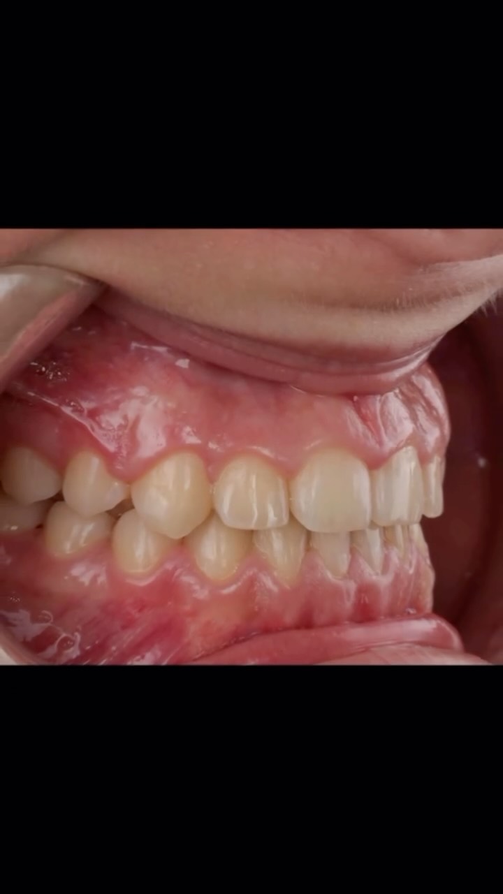 🦷 18 months. One dedicated patient. A smile that speaks for itself.
Our lovely patient just completed her orthodontic journey, and we are beyond proud of her results! ✨
Here’s what her treatment involved:
📐 Treatment Design & Planning — led by Dr. Matthew our principal dentist, who mapped out her full orthodontic plan from day one.
🙌 Hands-On by our oral Therapist Nancy, who guided and managed every stage of her active treatment.
🧼 Orthodontic Cleaning — a key part of the process! Keeping teeth clean during orthodontic treatment helps prevent decay and gum issues, setting the foundation for a healthy, lasting smile.
Did you know that with the right care and commitment, orthodontic treatment can be completed in as little as 18 months? 💡
If you’ve been thinking about straightening your smile, this is your sign. 👇
#Orthodontics #SmileTransformation #OrthodonticCleaning #DentalEducation