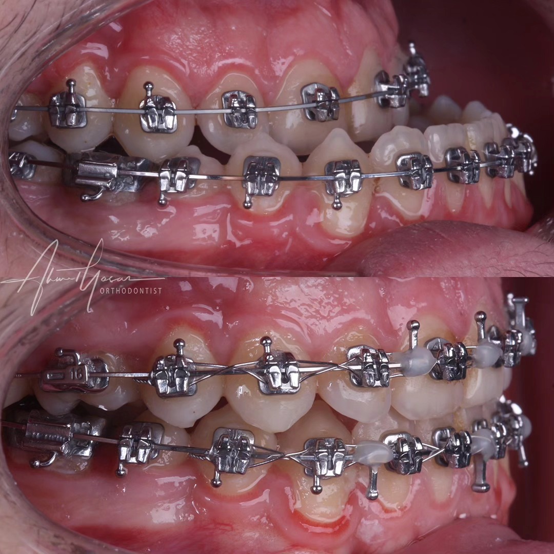 Tel teadvisi sonrası çene ameliyatı uygulaması💫
.
Our clinic is authorized by the Ministry of Health of the Republic of Türkiye for International Health Tourism. All patients have been informed and have provided consent for the use of their photographs on our social media platforms. All content shared on social media is intended to inform patients about procedures and should not be perceived as advertising. Outcomes of any surgical or interventional treatment may vary from person to person. It is recommended to consult your physician for detailed information before undergoing any procedure.
.
.
#ortodonti #ortodontist #bursa #fsm #bursaortodonti #bursaortodontist #bursaortodontiuzmanı #orthodontics #braces #teltedavisi #orthognathicsurgery #invisalignbursa #şeffafplak #lingualortodonti #dişteli #çeneameliyatı #selfligating #kapaklıbraket #gülüştasarımı #dent #dentistry #photography #estetik #dentalart #ahmetyasar #drahmetyasar