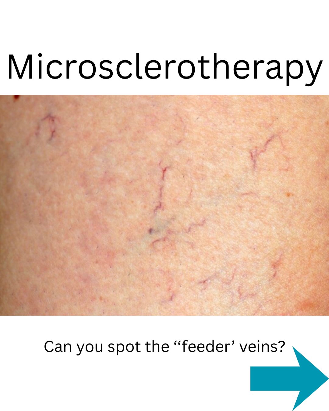 Ready to confidently treat spider and thread veins in clinic?
Our Microsclerotherapy Training is for practitioners who want to work safely, ethically and within best practice guidance — with real clinical understanding behind every injection.
On this course you will learn:
• ✔️ Lower limb vein anatomy made simple (including how to map leg veins clearly)
• ✔️ Reflux explained in an easy, practical way
• ✔️ Correct sclerosant selection and safe maximum volumes per session
• ✔️ When and how to repeat treatment appropriately
• ✔️ How to manage trapped blood correctly
• ✔️ Veins to avoid and essential safety red flags
• ✔️ Consultation, consent, documentation and complication management
This is high-level, hands-on training focused on patient safety, strong clinical foundations and achieving consistent, beautiful outcomes.
121 & Small groups. Clinical depth. Ongoing support.
#MicrosclerotherapyTrainingUK
#ThreadVeinRemoval
#AestheticTrainingUK
#UKAesthetics
#advancedaestheticpractitioner