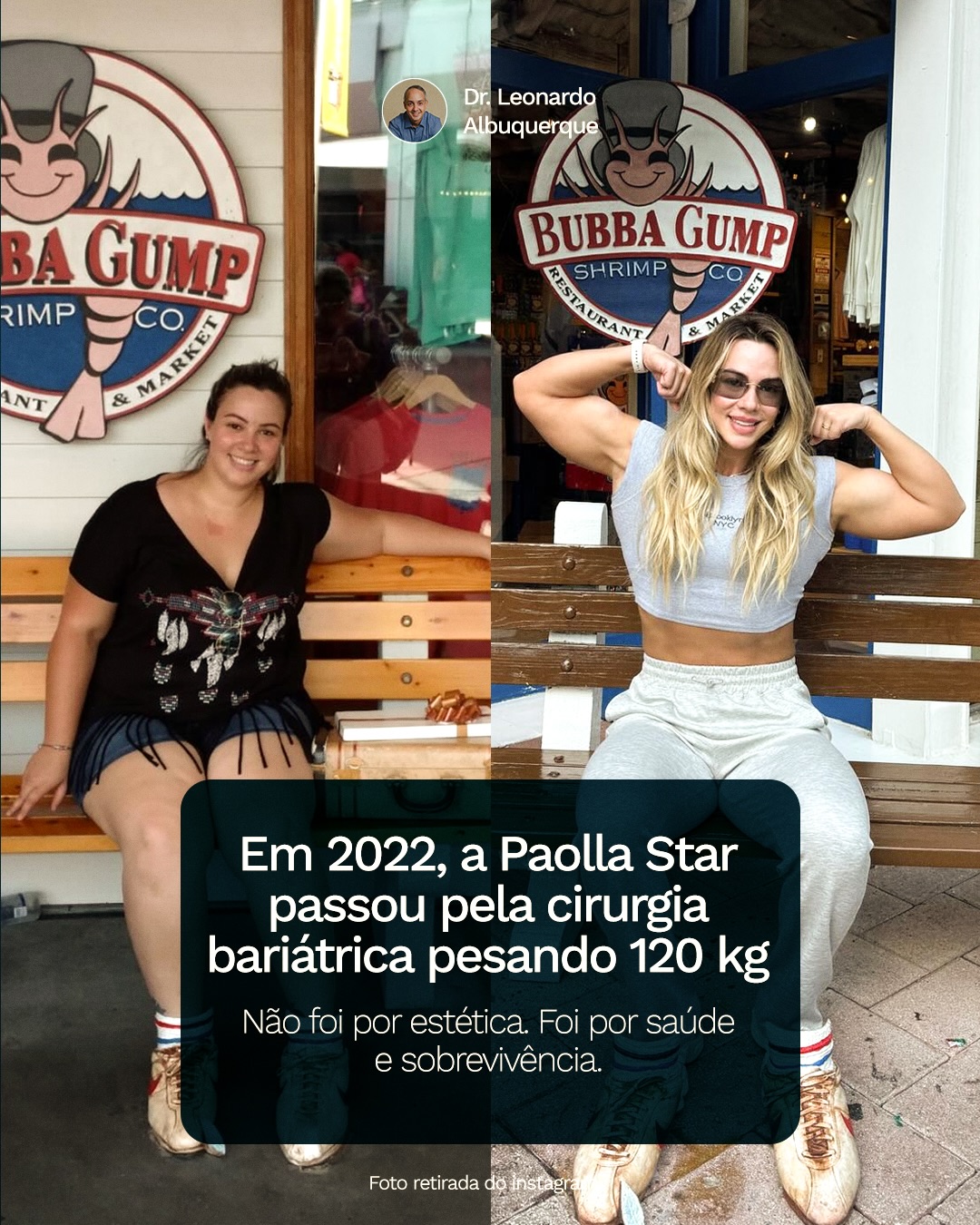 Mesmo com treino, dieta e disciplina,
o excesso de pele abdominal no pós-bariátrica
não regride sozinho.
Isso não tem relação com esforço.
Tem relação com biologia.
A cirurgia, nesses casos, não é sobre estética pura —
é sobre conforto, funcionalidade
e encerrar um processo que começou com saúde.
📲 Clique no link da bio e agende sua consulta para uma avaliação responsável.
Dr. Leonardo Albuquerque | Cirurgia Plástica
Formado pela USP e membro da SBCP
CRMBA 23068 | RQE 10486
📍Ilhéus – Bahia
.
.
.
#posbariatrica #abdodominoplastia #DrLeonardoAlbuquerque
