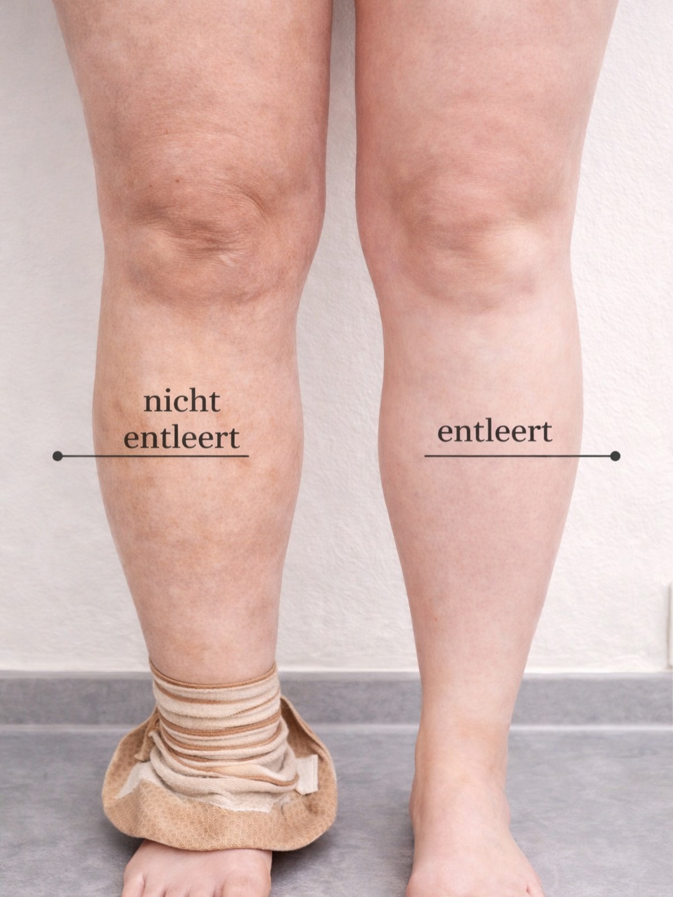 Nicht jedes „Problem“ ist Fett.
Manchmal ist es einfach ein Körper, der nicht richtig entleeren kann.
Wenn das Lymphsystem wieder in den Fluss kommt, verändert sich nicht nur das Bein
sondern das ganze Gefühl im Körper.
Entlastung. Leichtigkeit. Struktur. ✨Team Bodyrituals Madero 💛
#lymph #lymphaticdrainage #lymphödem #lipodem #madero