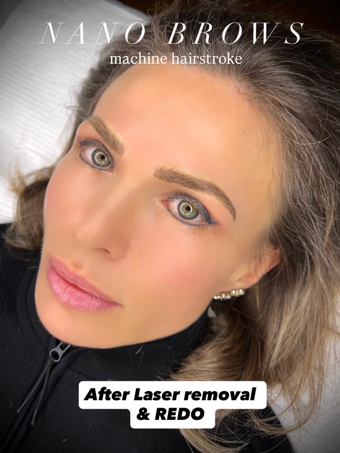 ✨Removal & Refresh the Brows ✨
My client came to me with old microblading that had become overly saturated and turned grey over time. Wanting a fresh start, she chose to undergo laser removal to create a clean canvas before redesigning her brows.
After 4 removal sessions, her goal was clear — soft, natural-looking brows without the harsh hair-stroke effect she previously experienced.
I recommended nano machine hairstrokes to achieve a refined, realistic result. The transformation speaks for itself: beautifully soft, natural brows tailored to her features.
She was truly amazed by the outcome and couldn’t be happier with her refreshed look.