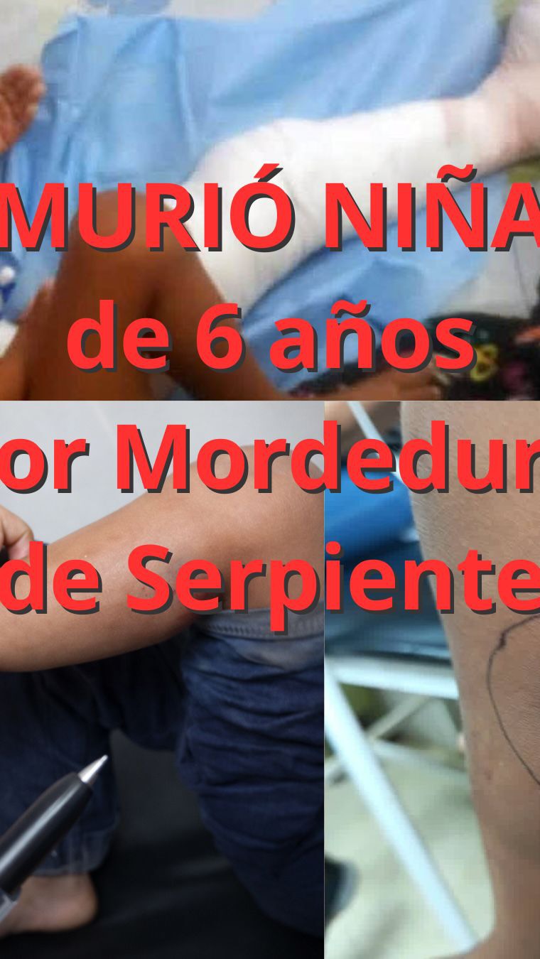 Niña de 6 años murió por una mordedura de serpiente.
En los accidentes graves por mapanare, cuando la neutralización es insuficiente:
• La necrosis avanza
• La coagulación se altera
• El riesgo sistémico aumenta
• Las decisiones se vuelven más complejas
En niños, el margen de error es menor.
Este caso nos deja una lección dura pero necesaria: En un envenenamiento grave, la diferencia entre vivir y morir muchas veces no es la serpiente. Es la dosis.
Desde la Fundación Vivarium seguimos educando para que esto no vuelva a ocurrir.
Un desenlace grave nunca depende de una sola variable. Tiempo de atención, condiciones del paciente y manejo inicial influyen. Aun así, la dosis correcta de antiveneno es clave.
📖 Lee el análisis completo en nuestro blog: fundacionvivarium.org/blog
#AccidenteOfidico #MordeduraDeSerpiente #ManejoClinico #Prevencion #Venezuela FundacionVivarium