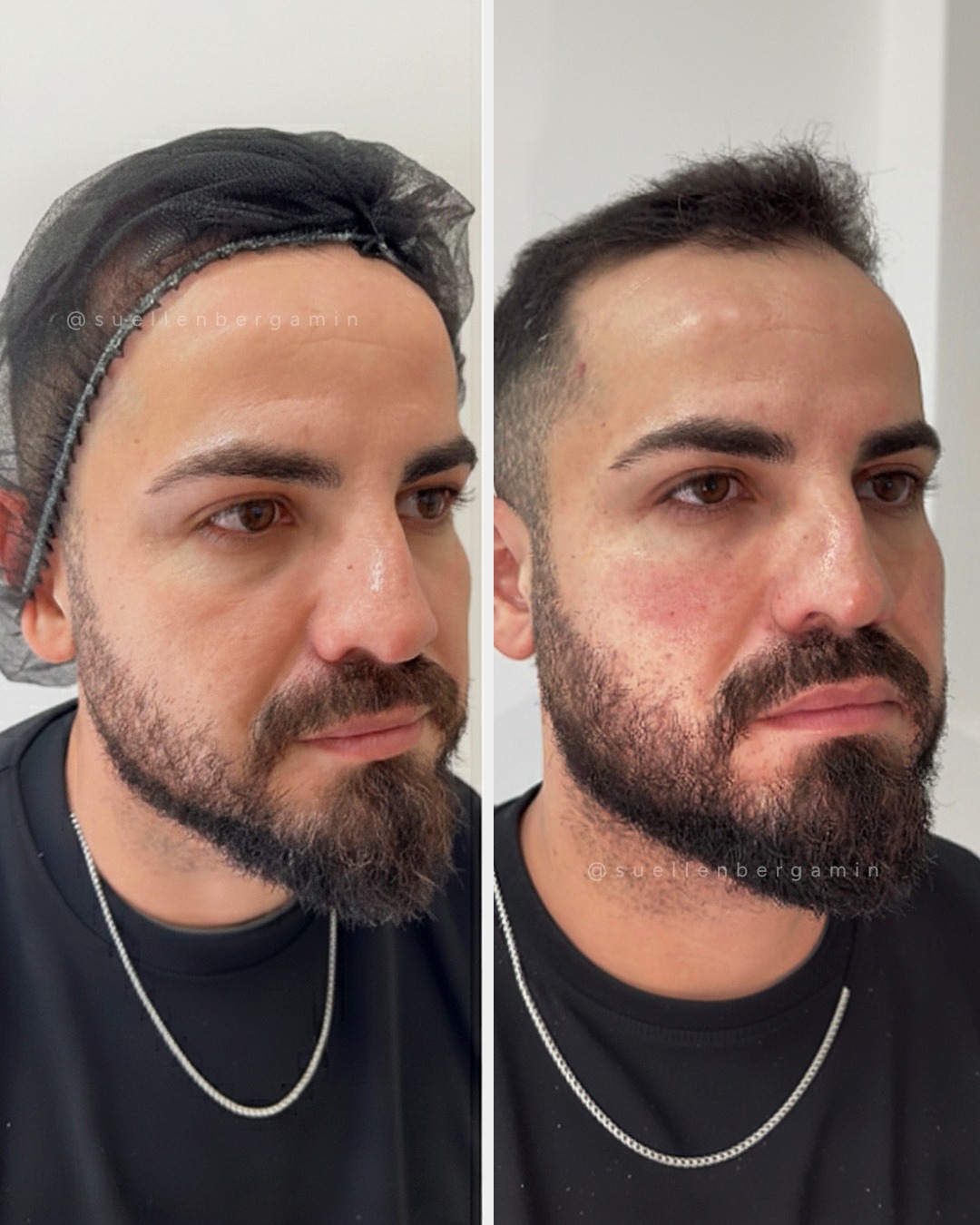 Ele não queria mudar o rosto.
Queria apenas que o espelho acompanhasse como ele se sentia.
Tratamos olheiras, bigode chinês, contorno de maxilar e linhas de expressão...
Tudo com equilíbrio, técnica e naturalidade.
Resultado em 1 hora. 😍
Sem exageros. Só alinhamento.
📲 Agende seu horário comigo: +44 7398 192413
.
He didn’t want to change his face.
He just wanted the mirror to reflect how he feels inside.
We treated dark circles, nasolabial folds, jawline contour, and expression lines…
All with balance, technique, and natural results.
Results in 1 hour. 😍
No exaggeration. Just alignment.
📲 Book your appointment with me: +44 7398 192413