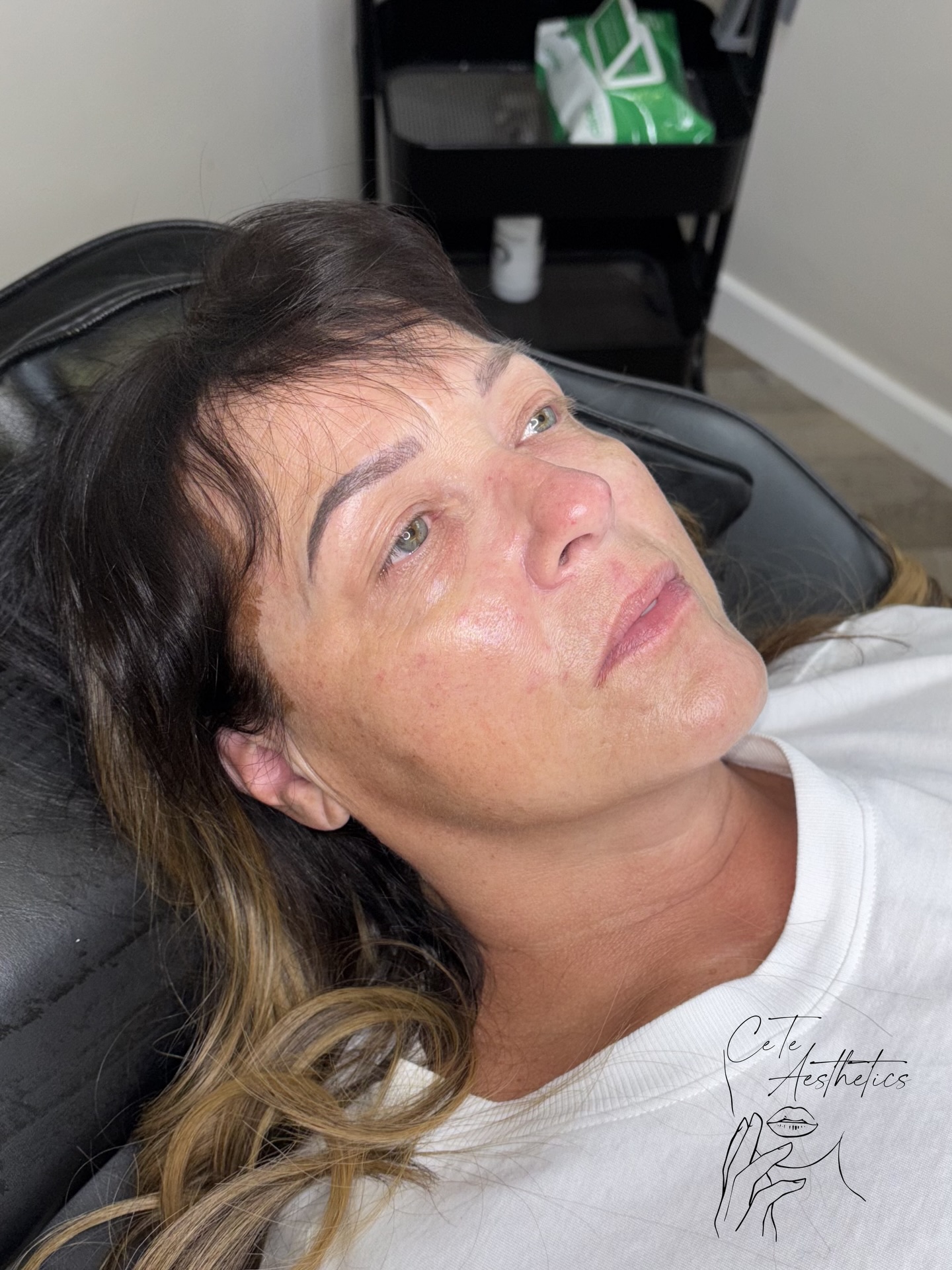 1ml Cheek Enhancement
1ml of dermal filler is strategically placed in the cheek area to:
• Restore volume lost from the malar fat pads
• Lift and support the mid-face
• Reduce the appearance of under-eye hollowness
• Soften signs of lower face ageing
• Create a fresher, more youthful contour
As we age, the cheeks naturally lose volume and descend, which can make the under-eyes look tired and the lower face appear heavier. By carefully restoring structure in the mid-face, we can subtly lift and rejuvenate without looking overfilled.
Results are natural, balanced and tailored to your facial anatomy
VERY LIMITED APPOINTMENTS AVAILABLE
Book online - www.ceteaesthetics.co.uk
——
#cheekaugmentation #cheeklift #aesthetics #facerejuvenation #scunthorpe