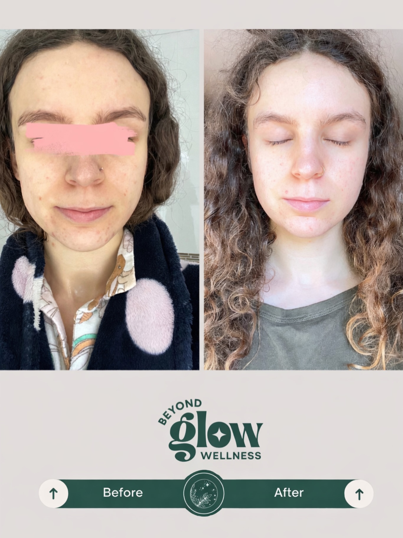 Acne improvement isn’t just about treating the surface of the skin, it’s about restoring balance within the skin and body.
This client’s results from cosmetic acupuncture show:
• Fewer active breakouts
• Reduced inflammation and redness
• Stronger, healthier skin barrier
• More even skin tone
• Refined pores and smoother texture
Cosmetic acupuncture works by increasing microcirculation, supporting collagen production, and helping regulate the inflammatory processes that drive many skin conditions.
At the same time, treatments support the nervous system and internal balance, which is why we often see improvements not only in skin clarity but in overall skin resilience.
🔎 Healthy skin is not just about what you put on the skin, but how the body functions underneath.
Results like this are the outcome of consistent treatments and supporting the skin from the inside out 🙌
📍Book via the link in bio
#cosmeticacupuncture #acupuncturefacial #acnetreatmentmelbourne #holisticskin #skinbarrierrepair