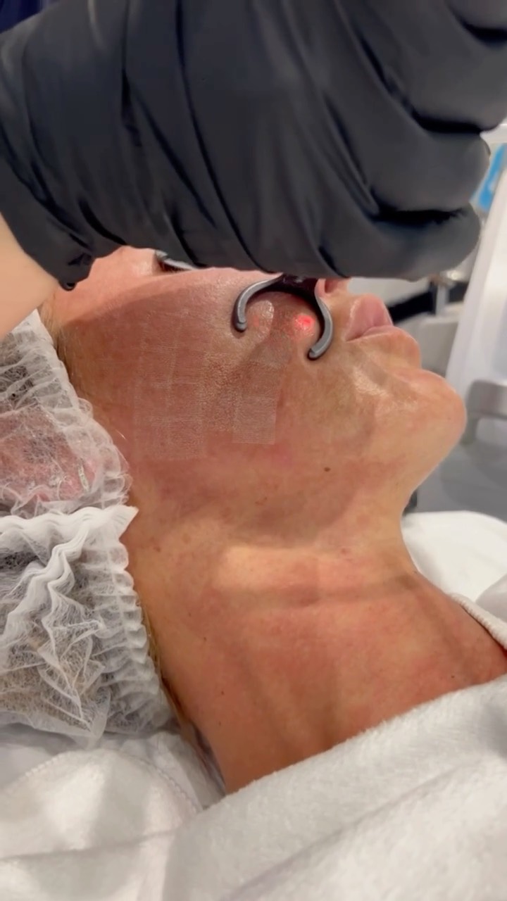 Ready to reveal brand-new skin? ✨
CO₂ laser resurfacing is one of the most powerful treatments for transforming tired, damaged skin from the inside out.
This advanced laser works by creating controlled micro-channels in the skin, stimulating intense collagen renewal while resurfacing the outer layers — revealing smoother, firmer, more even skin over time.
💎 Benefits of CO₂ laser resurfacing:
✔ Improves skin texture and tone
✔ Reduces pigmentation and sun damage
✔ Softens fine lines and wrinkles
✔ Minimises acne scars and enlarged pores
✔ Boosts collagen for long-term skin rejuvenation
The result? Clearer, smoother, more youthful-looking skin with lasting improvement.
📍 Elite Nurse Led Aesthetics – Wakefield
💬 Thinking about skin resurfacing?
Book your consultation today and let’s create a personalised skin plan ✨
#EliteNurseLedAesthetics #WakefieldAesthetics #CO2Laser #SkinResurfacing #AdvancedSkincare