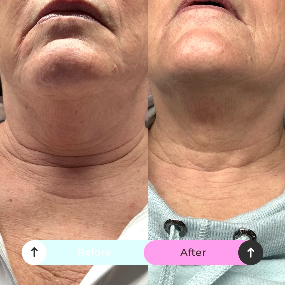 Just ONE session of Derma 2.0 tone up on the neck - for best results 2-4 sessions are recommended. using combination of microneedling & mesotherapy to create some incredible results for our client 💕 Turkey neck be gone 🦃
