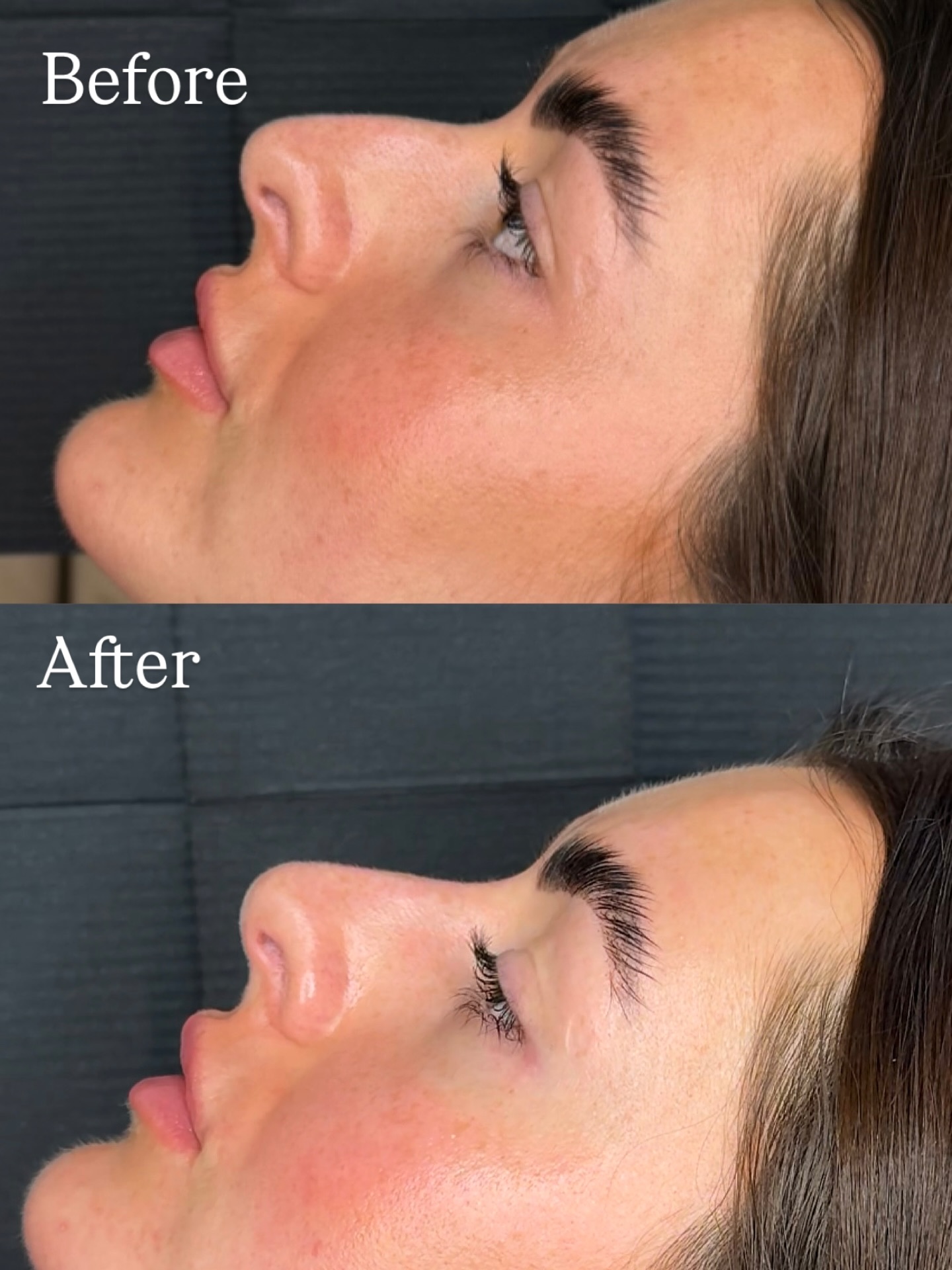 💉Liquid Rhinoplasty
✨Before & After
We kept this enhancement super subtle yet we got the best result! If only I recorded her reaction! it was everything🥹
Liv has always wanted to change her nose but has been too worried about the outcome, her only regret... not doing it sooner!
Liquid rhinoplasty doesn't need to be so dramatic, we can keep it super subtle around here... enhancements? What enhancements (your secret is safe with us 🤐🤫)
#liquidrhinoplasty #nosefiller #aesthetics #sunderland #aestheticsclinic #aestheticspractitioner #beforeandafter