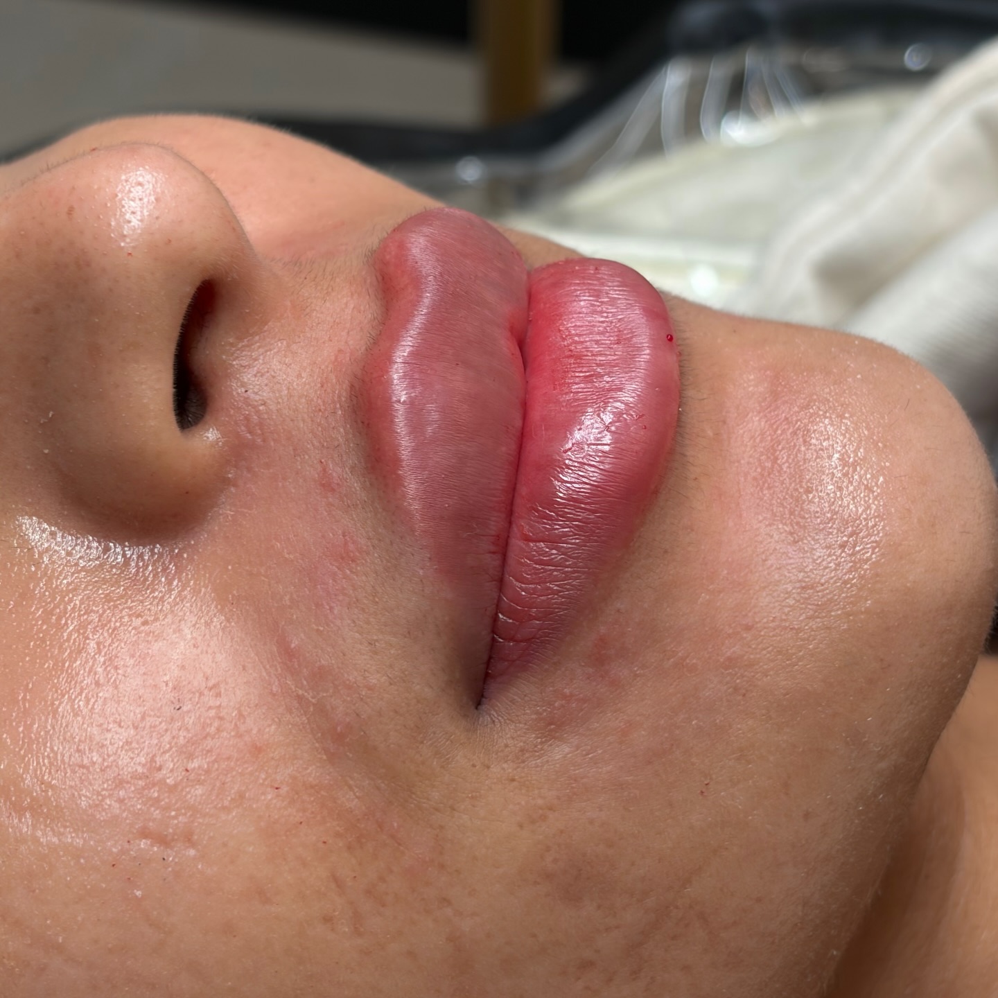 UNAPOLOGETICALLY REAL 🤍
These photos were taken immediately after treatment.
No filters.
No editing.
No blurring.
Just real skin and real results.
You’ll notice a little redness, slight swelling and tiny injection points — completely normal straight after lip filler and part of the real treatment process.
Over the next few days the lips will soften as the filler settles and integrates into the tissue.
Lip enhancement should never be a one-size-fits-all treatment. Every set of lips requires a tailored technique, carefully considering lip anatomy, projection, balance and facial harmony.
Technique matters.
Anatomy knowledge matters even more.
This is exactly the level of precision we teach our students at Urban Angel Aesthetics, through our Ofqual regulated aesthetics qualifications (Levels 3–7).
Real work.
Real technique.
Real education.