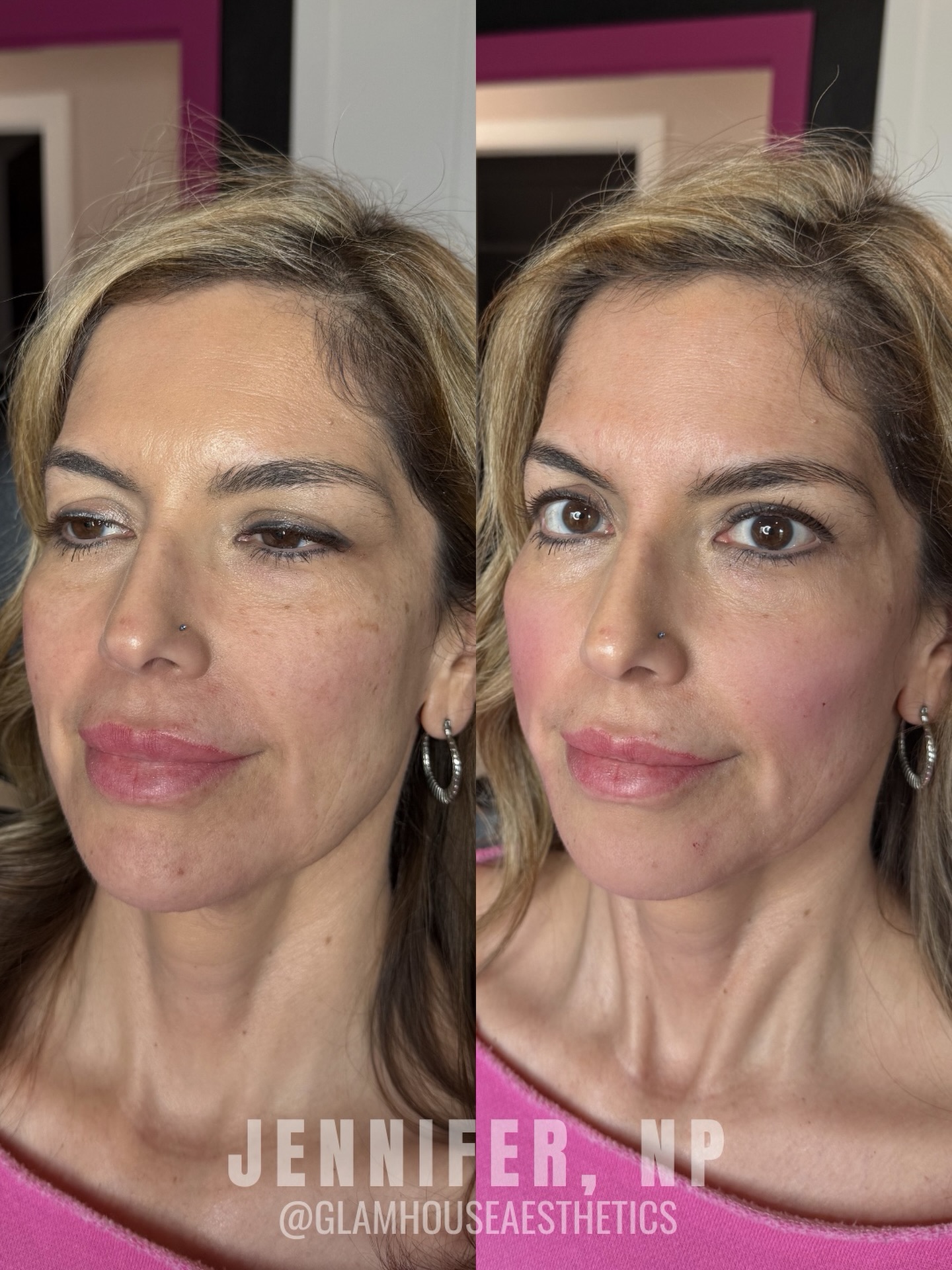 We used RHA 4 to support the cheeks and RHA 3 through the lower face to soften early jowling and restore balance. By rebuilding support where volume had started to shift, the jawline appears cleaner and the face looks more rested without changing her natural features.
Every treatment plan is customized to anatomy, goals, and safety. Book your filler appointment today! â¨
Glamhouse Aesthetics & Wellness | San Antonio Aesthetics | New Braunfels Aesthetics | MedSpa | Filler | RHA