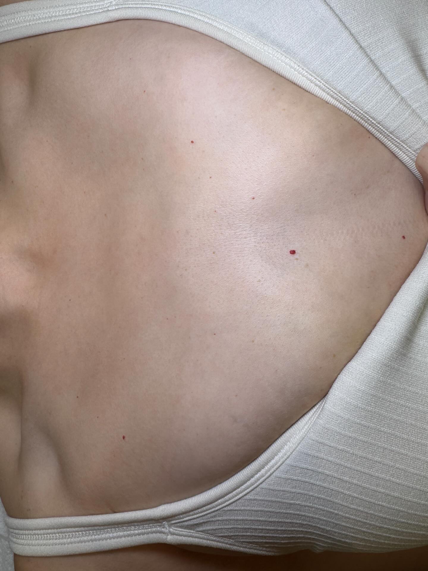 🍒Cherry Angioma🍒Removal Season is here babeh! Now is the perfect time to get rid of these pesky red dots before spring vacation and summer is here. We removed 22 angiomas in less than 15 minutes. It’s painless, about $1200 cheaper than laser (and way more effective) and there’s no down time or aftercare. You’ll want to wear loose clothing and avoid sweating for 48 hours but that’s it!
Let’s go! I’ve been removing these since 2003 and I was trained by the doctor that invented the machine, just sayin, you’re in good hands 🤗 Call 737.802.3199 to book your 30 min session with me at least a week before your next vacation!
