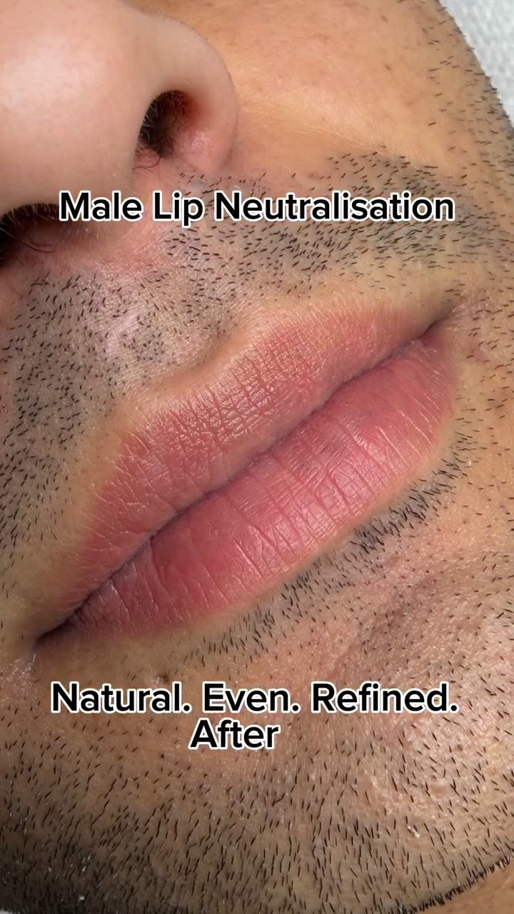 Male lips require precision — not pigment overload. ✨
This case presented uneven tone, with darker pigmentation on the upper lip and lighter areas below. Through advanced lip neutralisation, I restored balance and natural colour harmony in just one session. 🫶
Pigments used @evenflocolours
Lip correction isn’t gender-specific. It’s about expertise.
Book your consultation via the link in my bio.
#pmu #pmuartist #lipneutralization #lipneutralisation #spmucardiff