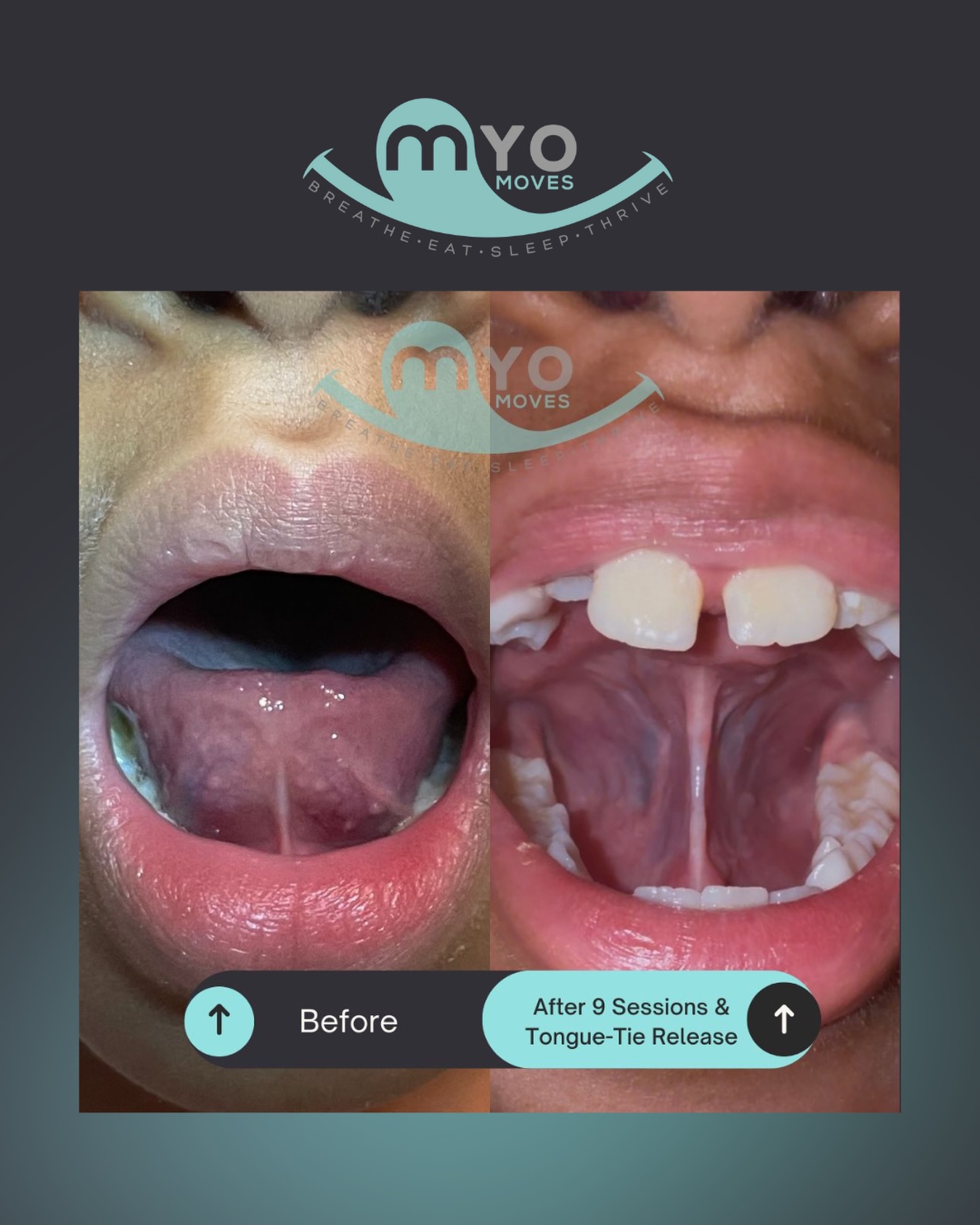 ✨ Can you believe this transformation?! ✨
After just 9 Myo Moves sessions + a tongue-tie release, this little one has a completely different tongue posture and it’s changing everything!
Before: A restricted tongue, held down by a tight frenulum. Limited mobility, Poor posture and improper function.
After: A free, high-resting tongue with better lift, shape, and space.
This kind of progress supports:
✅ Better nasal breathing
✅ Improved sleep + focus
✅ Healthier swallowing patterns
✅ Full-body regulation + development
Because here’s the thing: the release is just the beginning!! Myofunctional therapy teaches the tongue how to move, rest, and function the way it was meant to, for lasting results.
💬 Wondering if your child might have a tongue-tie? Comment “TONGUE TIE” and we’ll send you info on what to look for + how we can help.
#TongueTie #BeforeAndAfter #AirwayHealth #breathebetter #myofunctionaltherapy