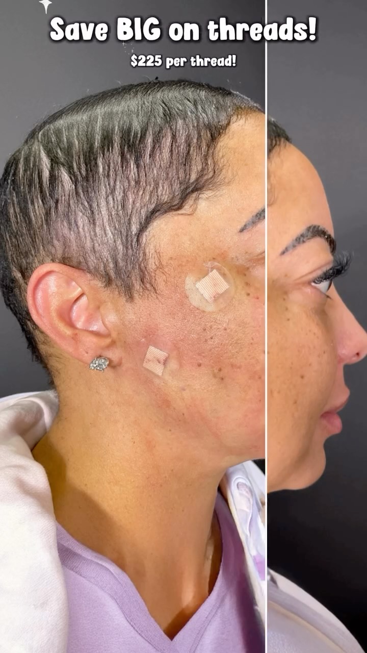 The power of PDO Threads ✨
This transformation shows what happens when we stimulate your skin to rebuild itself. PDO threads lift and tighten while boosting your natural collagen, helping restore definition and a smoother, firmer look over time.
If you’ve been noticing sagging, loss of jawline definition, or skin that just doesn’t feel as tight as it used to, PDO threads can create a natural looking lift without surgery or long downtime.
Right now at Pretty Faces Atlanta, take advantage of our $225 per thread special and start your own transformation while the sale lasts.
#PDOThreads #SkinTightening #CollagenBoost #AestheticResults #PrettyFacesAtlanta ✨