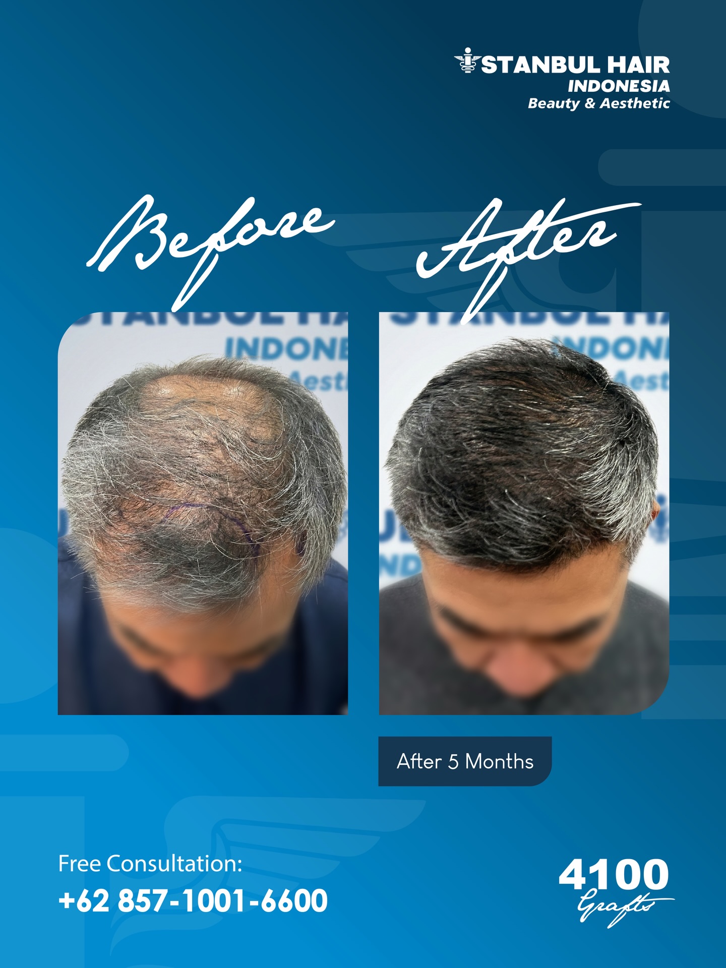 💼 4.100 grafts — 5 bulan pasca tindakan
Transformasi mulai matang. Volume tampak lebih solid, garis depan tersusun presisi dengan hasil yang menyatu alami.
⸻
💼 4,100 grafts — 5 months post procedure
The transformation is taking shape. Fuller coverage, a refined frontal line crafted with precision and natural harmony.
📍 Istanbul Hair Indonesia
📞 +62 857-1001-6600
#IstanbulHairIndonesia #4100Grafts #5MonthsResult #RefinedHairline #PremiumHairTransplant