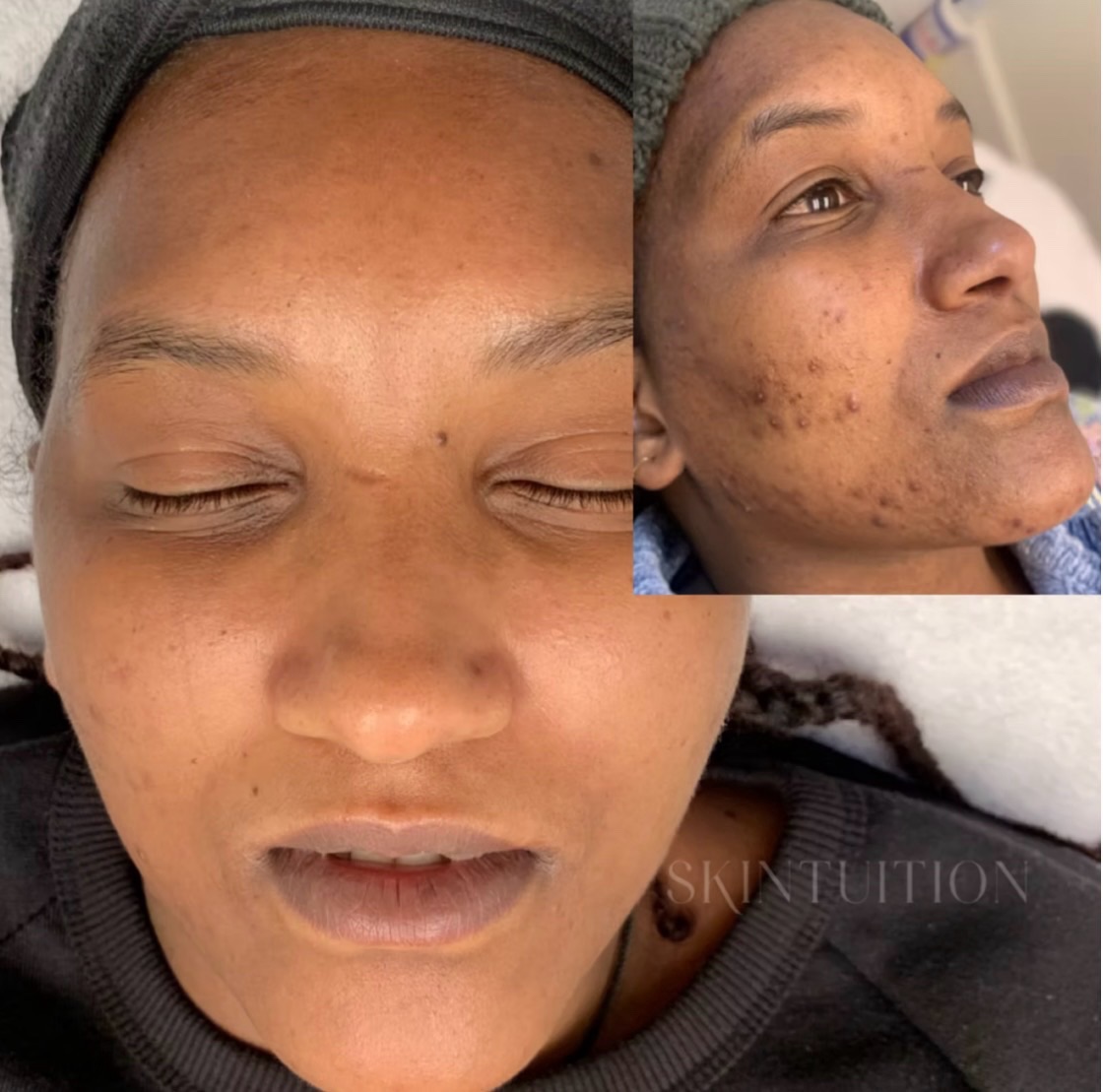 Acne isn’t random.
It’s not “bad skin.”
And it’s definitely not something you just have to live with.
Our Acne Boot Camp is a customized, corrective program designed to get to the root cause and clear your skin the right way — no guessing, no trends, no band-aids.
Consistency. Education. Real results.
Ready to commit to clear skin? 🤍
Book your consultation to get started
#louisvilleskincare #louisvilleacne #louisvillespa