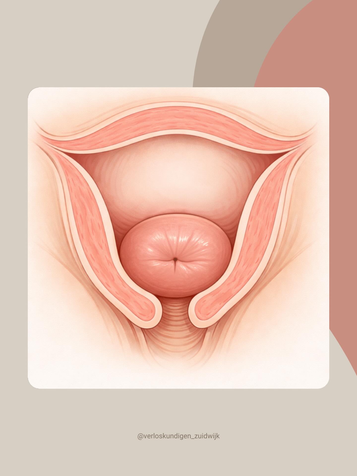 Wat beoordelen we eigenlijk bij een inwendig onderzoek? ✨
Tijdens de bevalling voelen we niet alleen naar het aantal centimeters ontsluiting. We beoordelen meerdere belangrijke aspecten. Dat vatten we samen met de afkorting POVIAS.
• Portio: is de baarmoedermond week of nog stug? Ligt hij centraal of nog naar achter? Is het nog een “tuutje” of al verstreken?
• Ontsluiting: hoeveel centimeter opening is er?
• Vliezen: zijn de vliezen nog intact of gebroken?
• Indaling: hoe diep is het hoofdje in het bekken gezakt?
• Aard: voelen we daadwerkelijk een hoofdje?
• Stand: hoe ligt het hoofdje? Dit bepalen we aan de hand van de schedelnaden.
Een inwendig onderzoek geeft dus een totaalbeeld van hoe de bevalling vordert 👶🏼
Op de foto zie je hoe een baarmoedermond er van binnen uitziet (de roze “donut” op de afbeelding). Dit is een staande baarmoedermond: nog niet verstreken en zonder ontsluiting.
#bevalling #verloskundige #baarmoedermond
