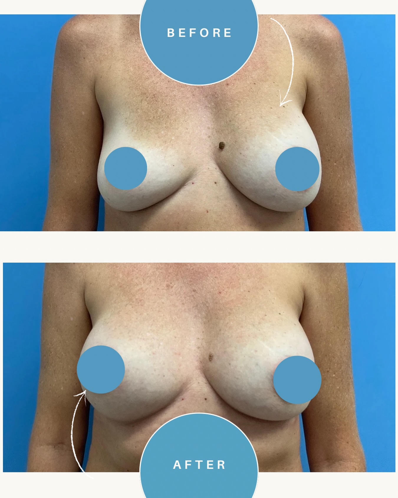 Ruptured implant? You have options.
This patient required revision surgery to remove a ruptured implant and replace both for symmetry using SMPX 325cc implants bilaterally.
• Saline implant deflation requires surgical replacement
• Silicone implant rupture requires implant exchange plus capsulectomy (removal of scar tissue surrounding the implant)
If you notice changes in shape, firmness, or volume don’t ignore them. Early evaluation is key.
📞 Contact Dr. Chu’s office today to discuss your next steps. 808-524-1551
.
.
.
#BreastImplantRevision #ImplantExchange #PlasticSurgeryHonolulu #DrBenjaminChu #breastaugmentation