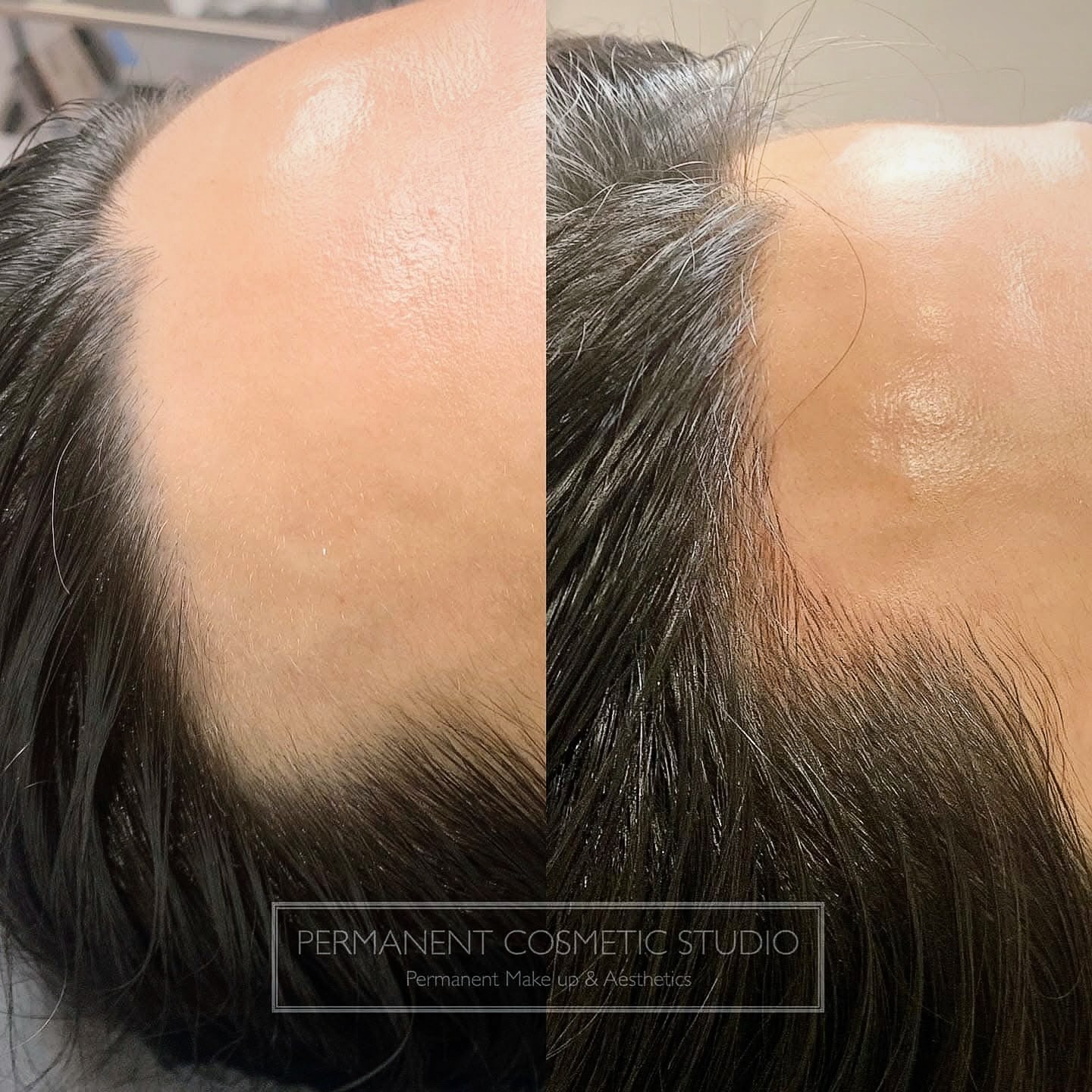Restoring a receding hairline with a delicate strokes of frontal hairline microblading…. 😍😍
.
.
.
.
#ScalpMicroblading
#ScalpPigmentation
#HairlineRestoration
#SMPArtist
#HairLossSolutions